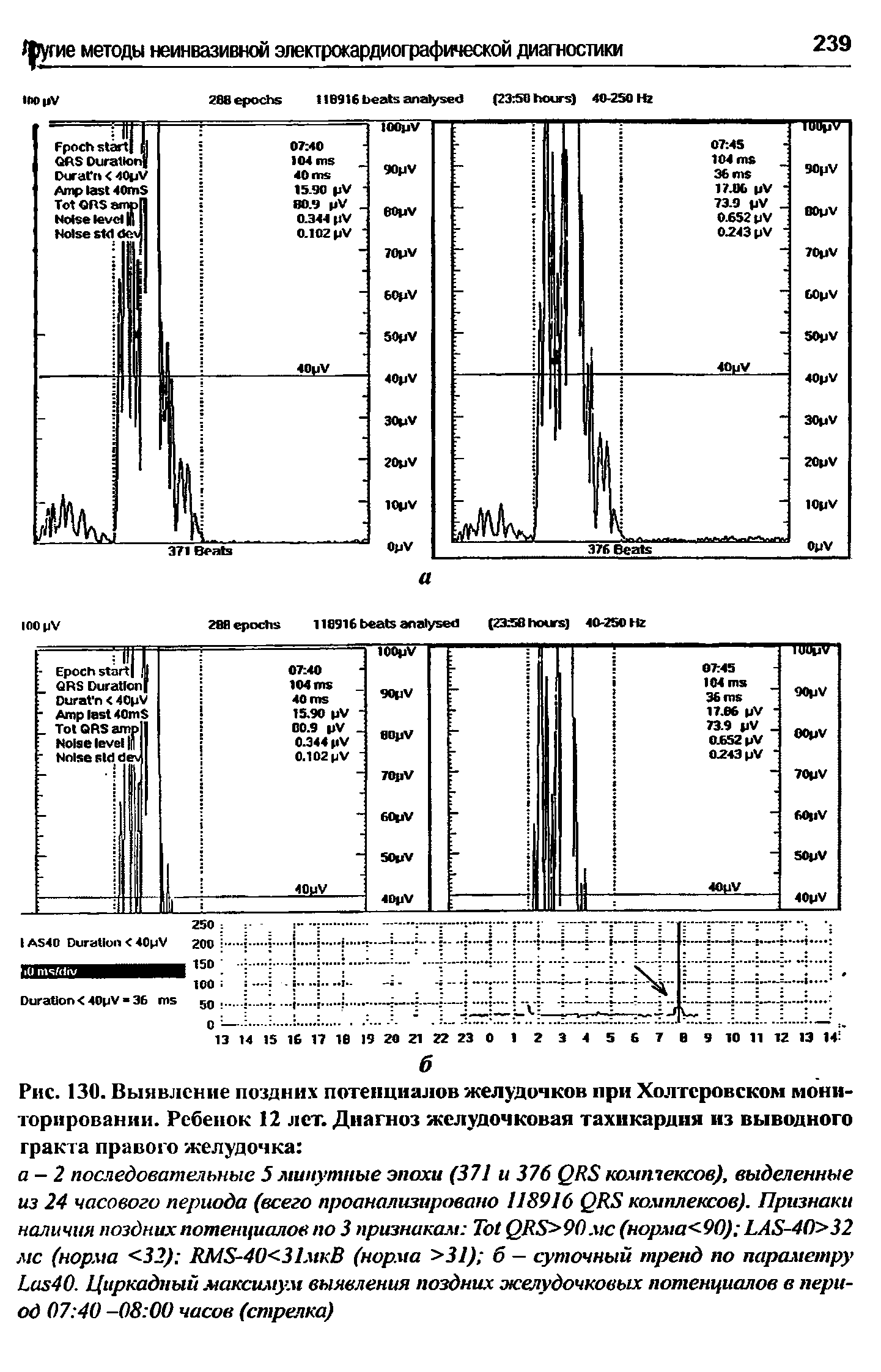 Рис. 130. Выявление поздних потенциалов желудочков при Холтеровском мониторировании. Ребенок 12 лет. Диагноз желудочковая тахикардия из выводного...