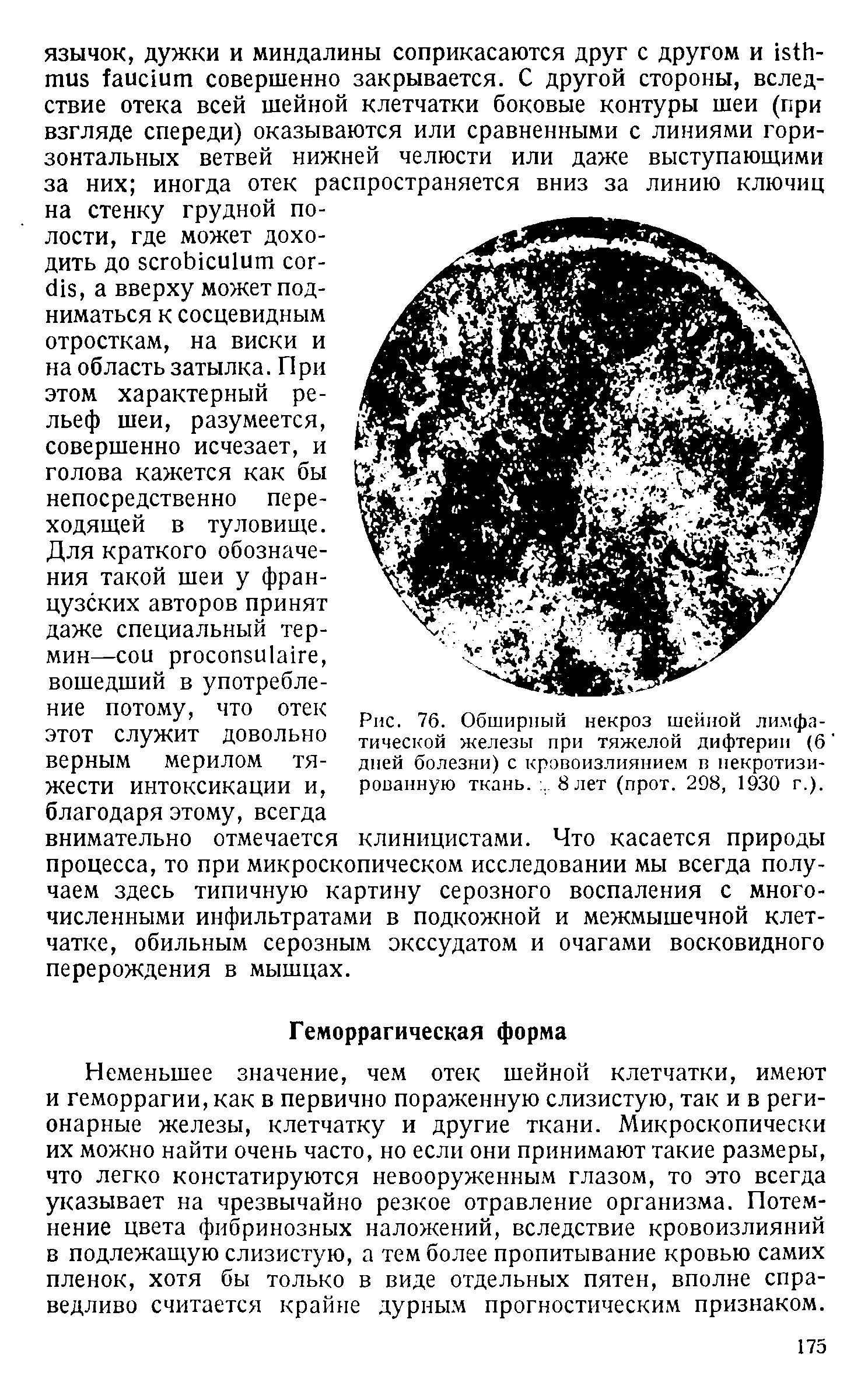 Рис. 76. Обширный некроз шейной лимфатической железы при тяжелой дифтерии (6 ...