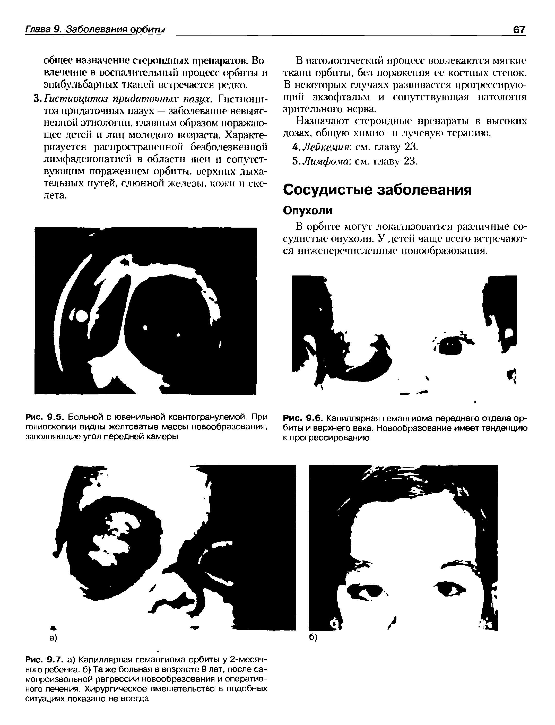 Рис. 9.5. Больной с ювенильной ксантогранулемой. При гониоскопии видны желтоватые массы новообразования, заполняющие угол передней камеры...