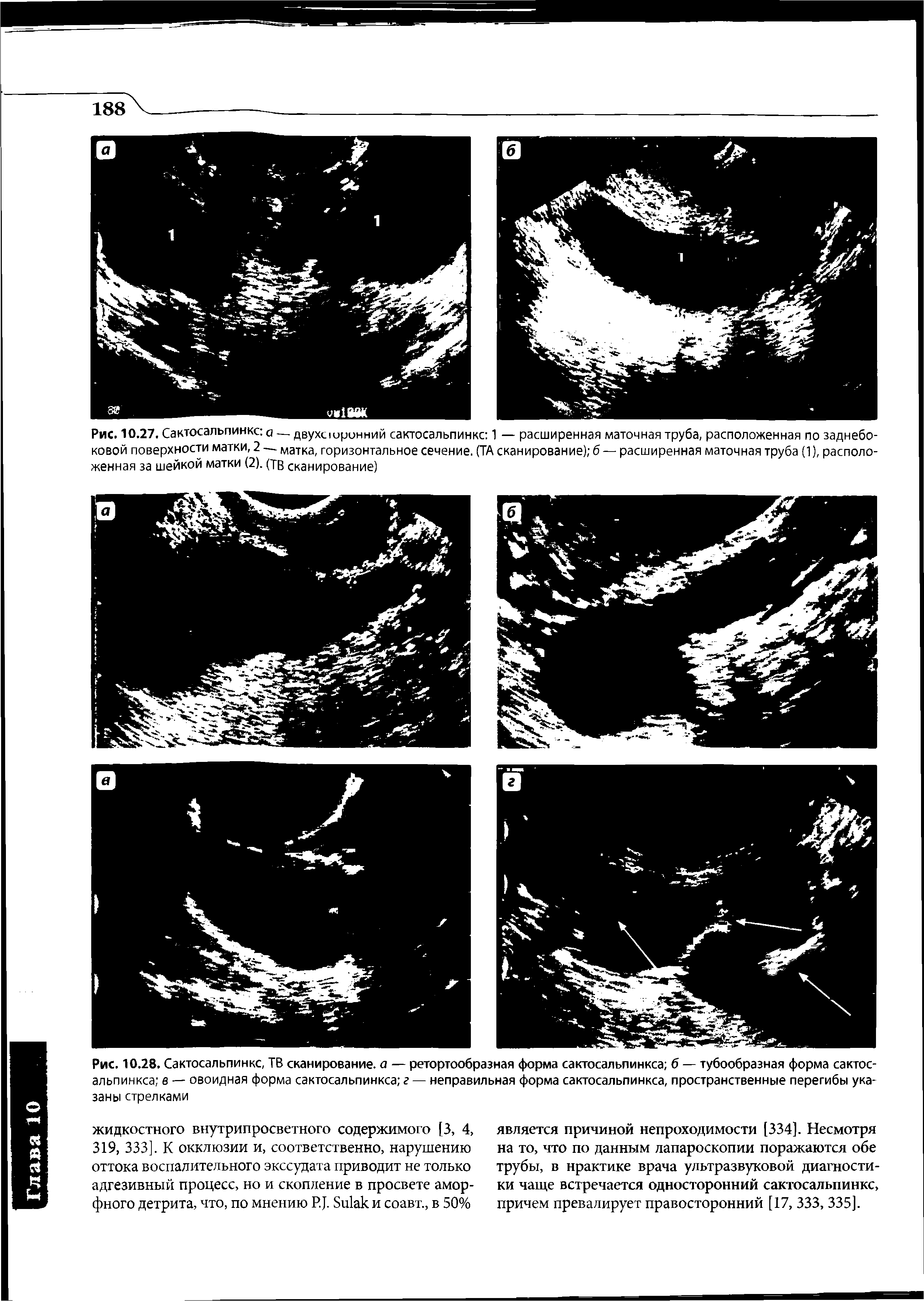 Рис. 10.28. Сактосальпинкс, ТВ сканирование, а — ретортообразная форма сактосальпинкса б — тубообразная форма сактос-альпинкса в — овоидная форма сактосальпинкса г — неправильная форма сактосальпинкса, пространственные перегибы указаны стрелками...
