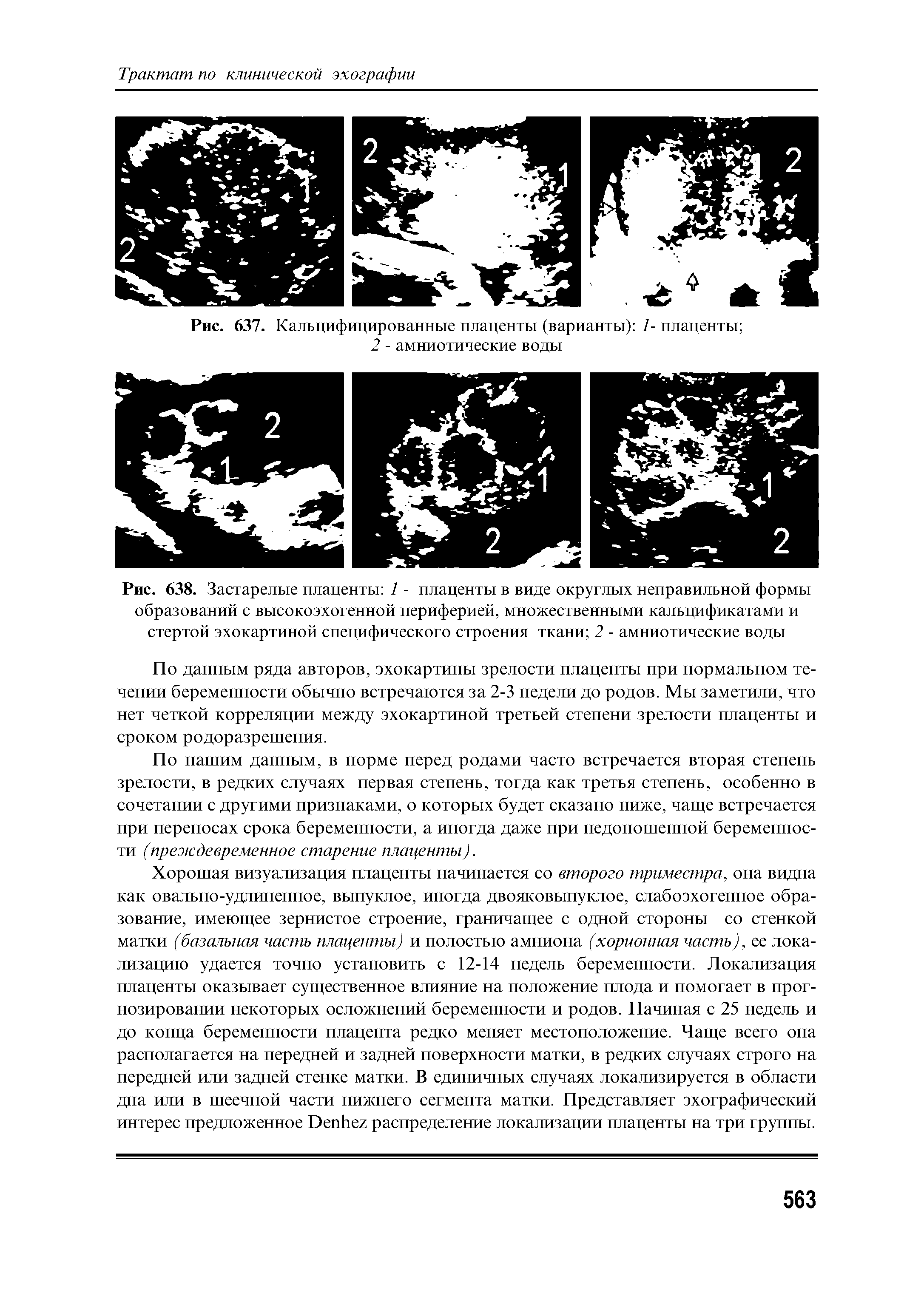 Рис. 638. Застарелые плаценты 1 - плаценты в виде округлых неправильной формы образований с высокоэхогенной периферией, множественными кальцификатами и стертой эхокартиной специфического строения ткани 2 - амниотические воды...
