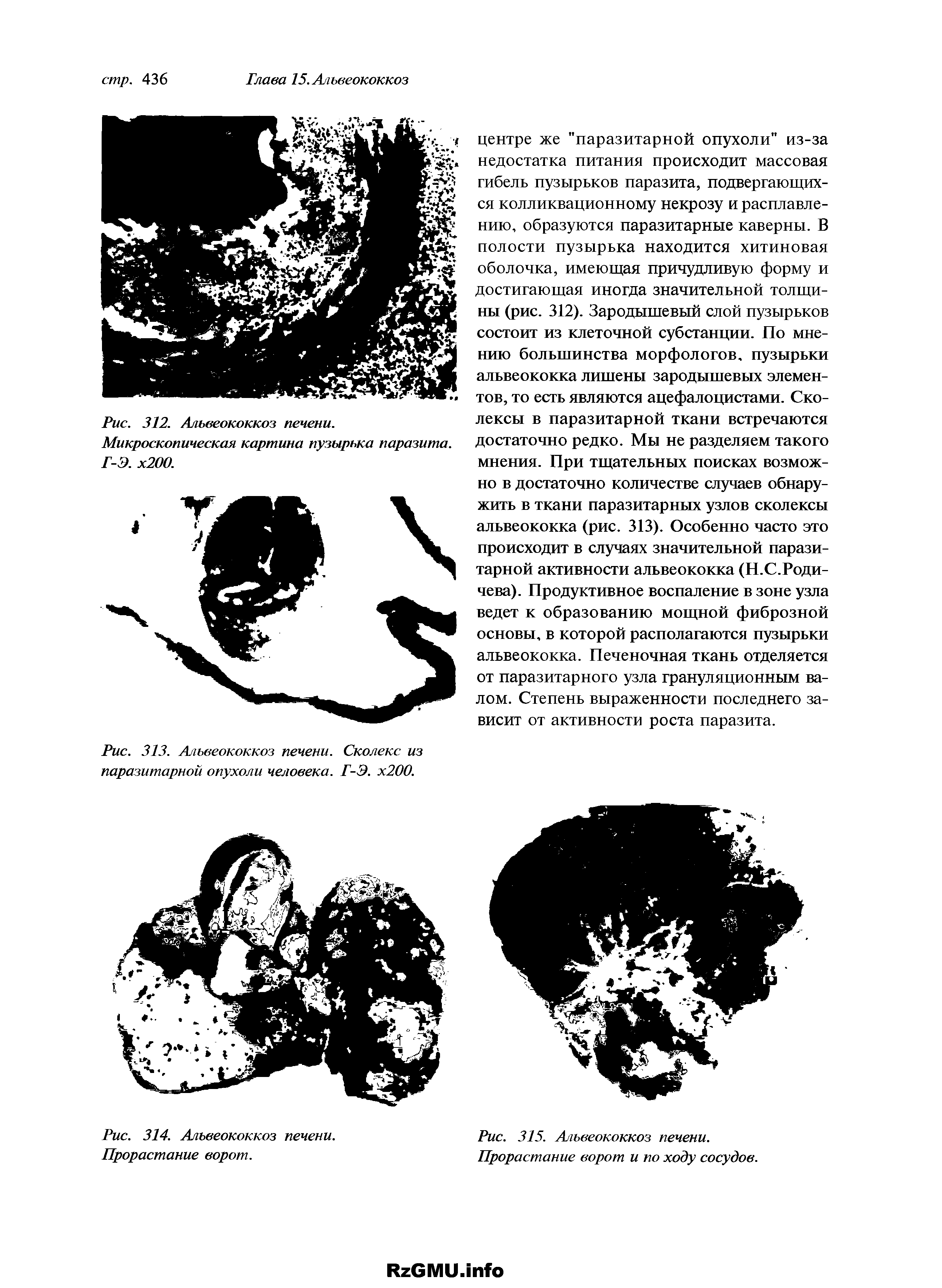 Рис. 313. Альвеококкоз печени. Сколекс из паразитарной опухоли человека. Г-Э. х200.