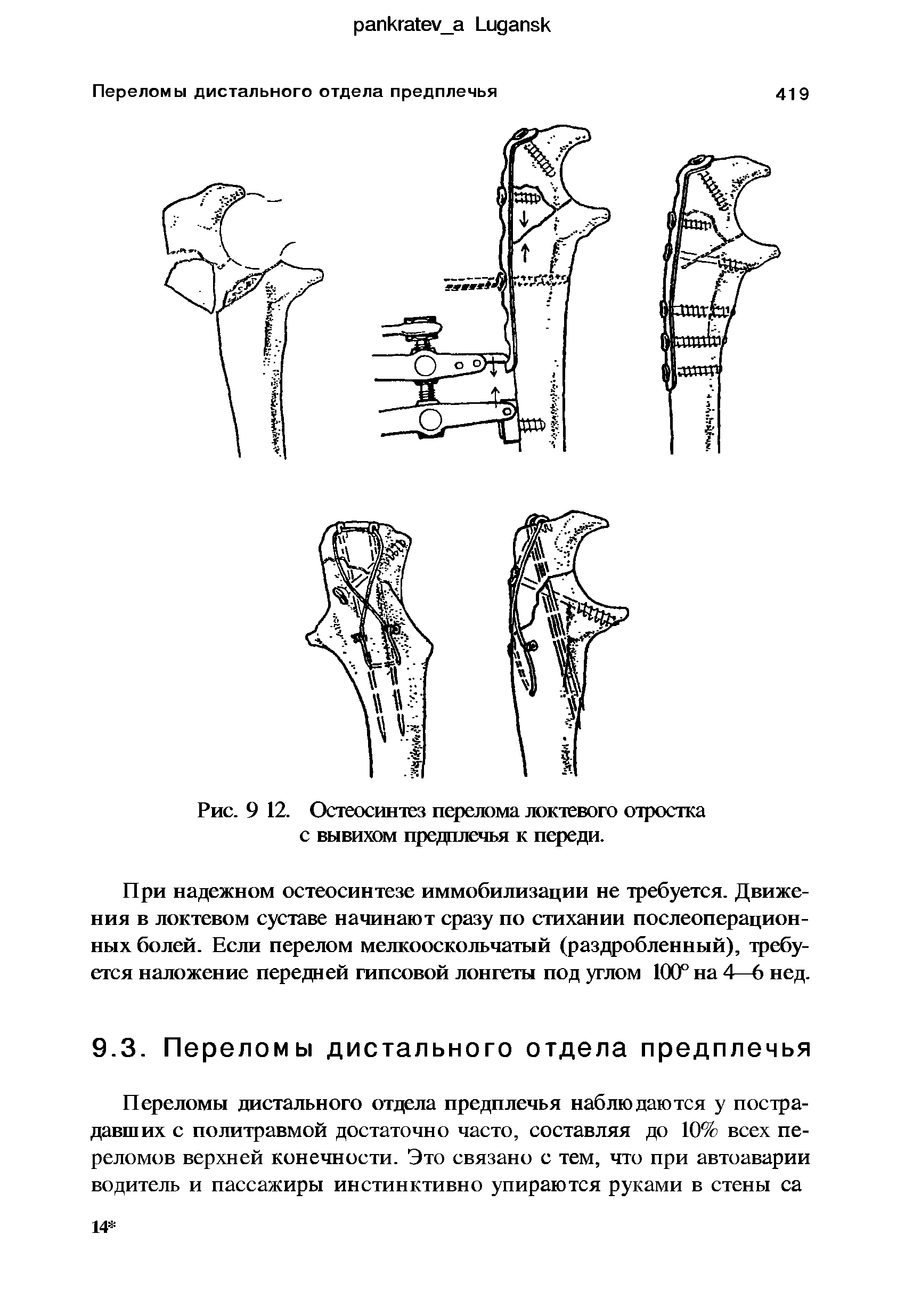 Рис. 9 12. Остеосинтез перелома локтевого отростка с вывихом предплечья к переди.