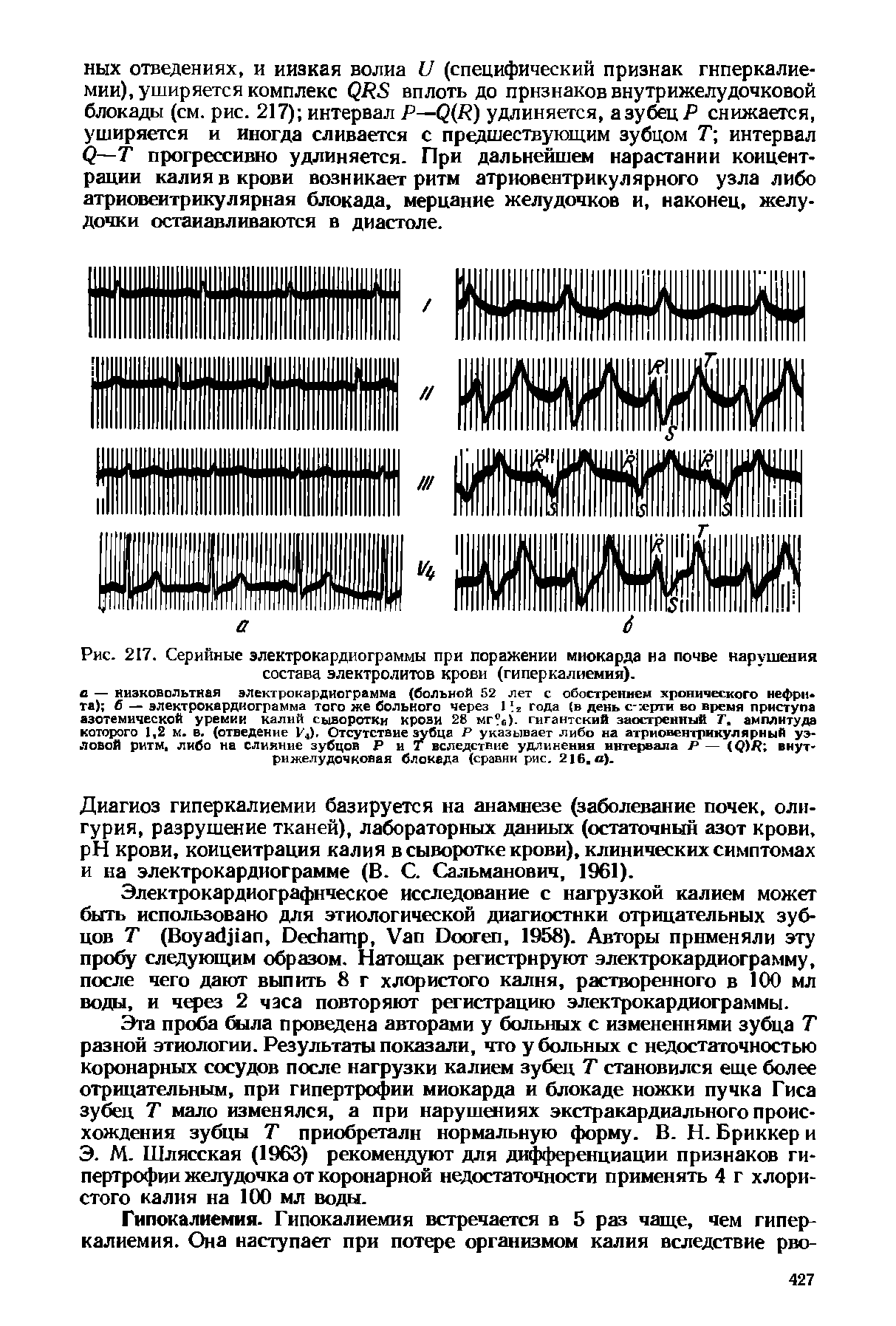 Рис. 217. Серийные электрокардиограммы при поражении миокарда на почве нарушения состава электролитов крови (гиперкалиемия).