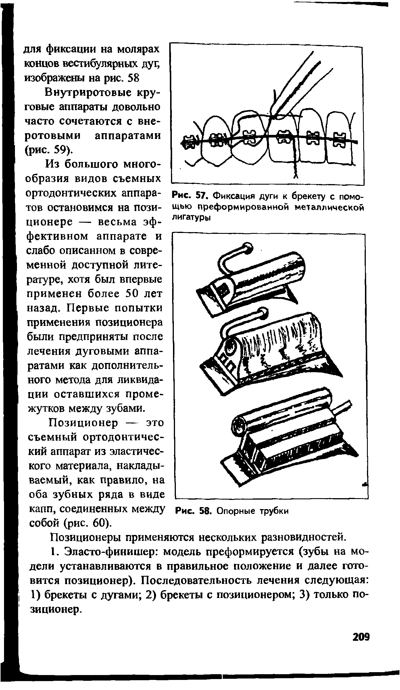 Рис. 57. Фиксация дуги к брекету с помощью преформированной металлической лигатуры...