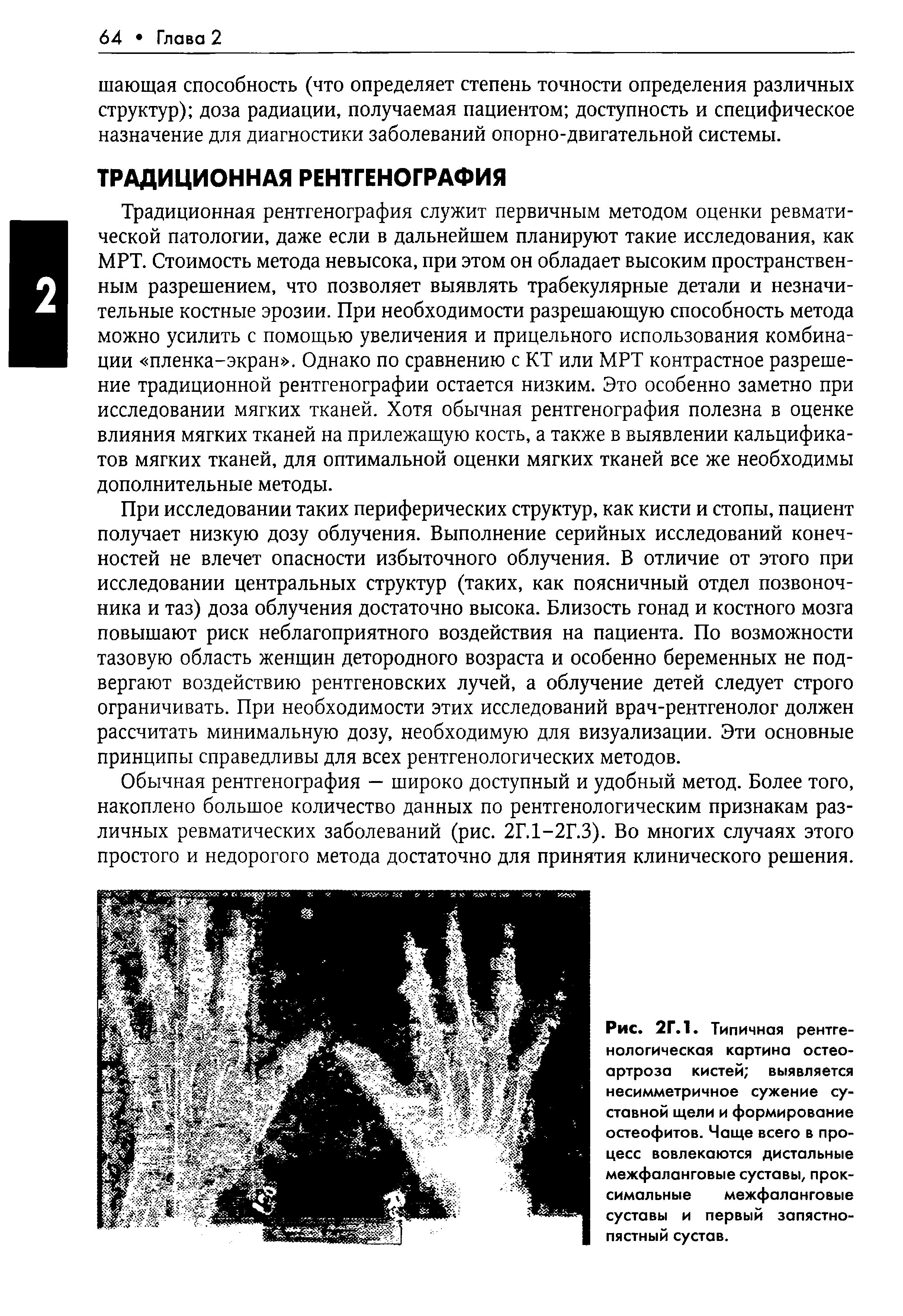 Рис. 2Г.1. Типичная рентгенологическая картина остеоартроза кистей выявляется несимметричное сужение суставной щели и формирование остеофитов. Чаще всего в процесс вовлекаются дистальные межфаланговые суставы, проксимальные межфаланговые суставы и первый запястнопястный сустав.