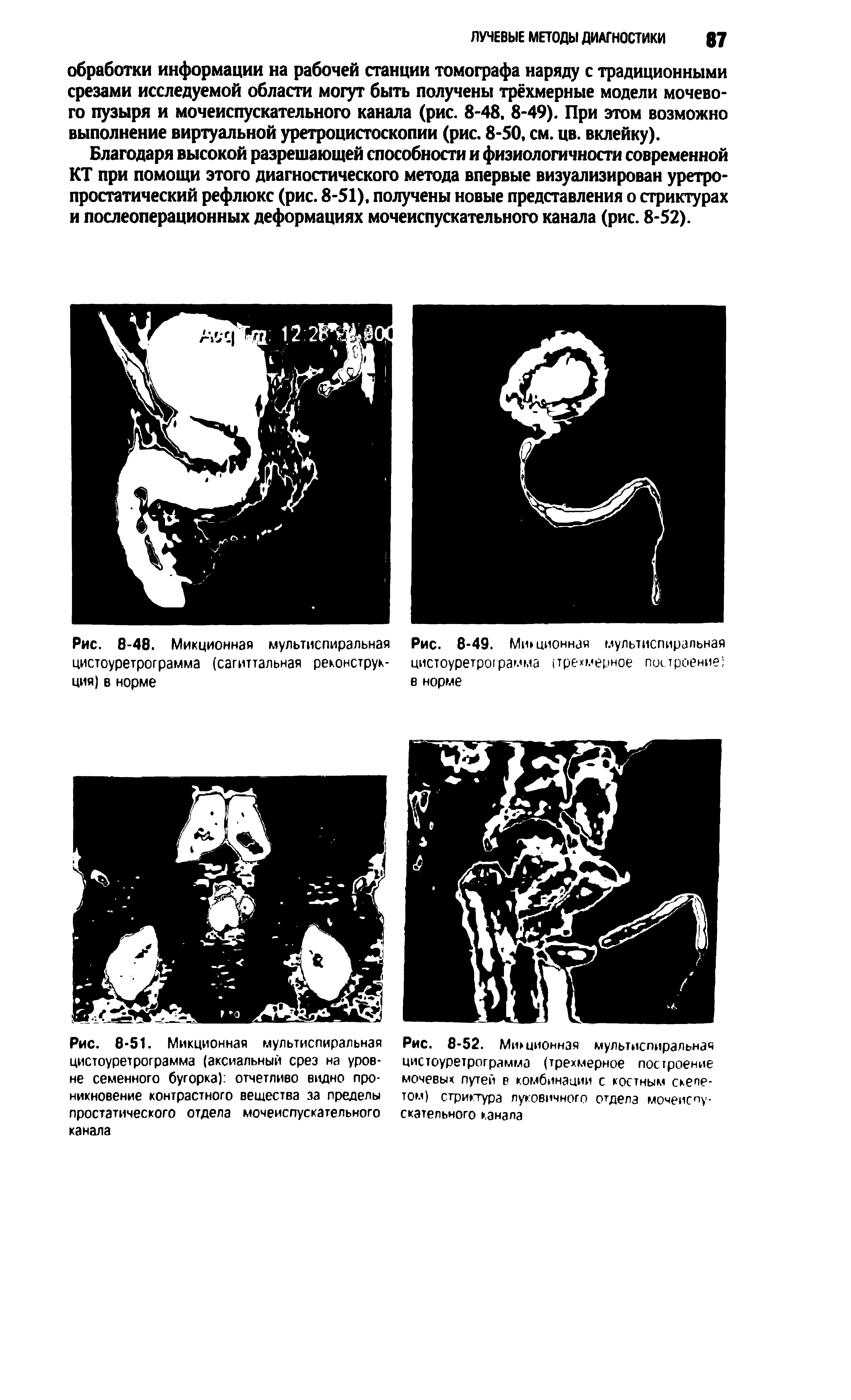 Рис. 8-51. Микционная мультиспиральная цистоуретрограмма (аксиальный срез на уровне семенного бугорка) отчетливо видно проникновение контрастного вещества за пределы простатического отдела мочеиспускательного канала...