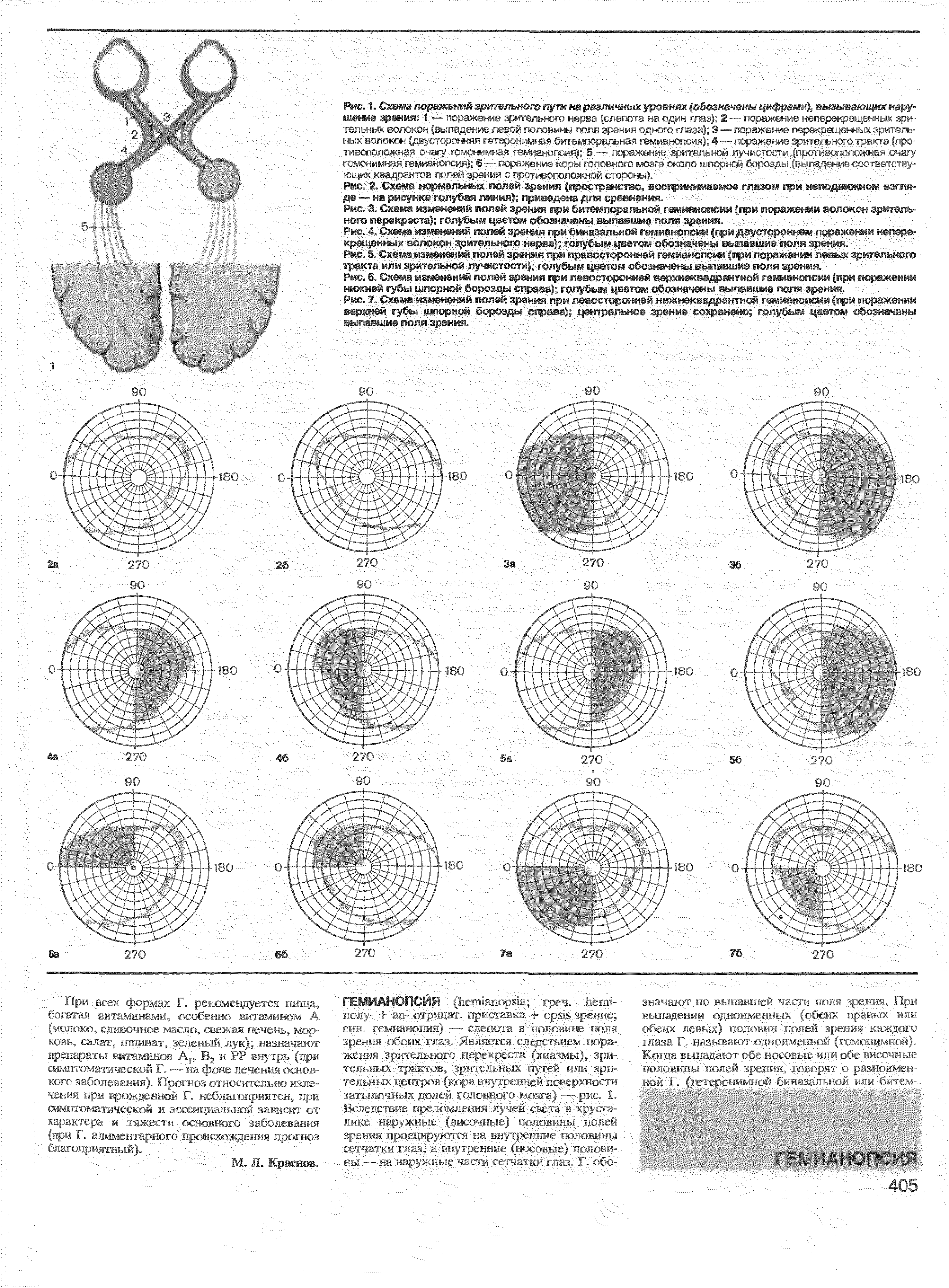 Рис. 3. Схема изменений полей зрения при битемгкзральной гемианопсии (при поражении волокон зрительного перекреста) голубым цветом обозначены выпавшие поля зрения. /д// Аг -, - э,/г - (( ( ( ...