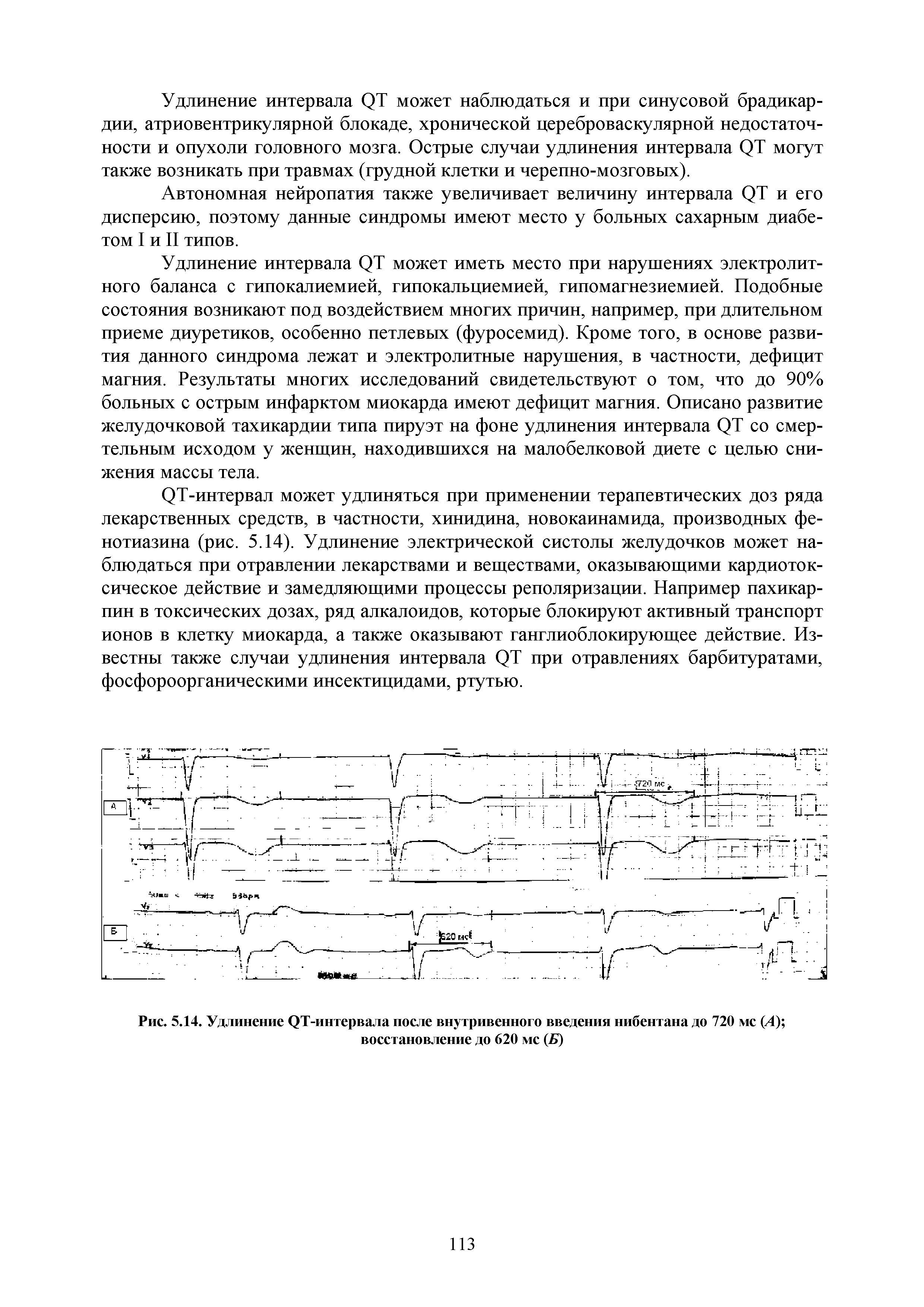 Рис. 5.14. Удлинение QT-интервала после внутривенного введения нибентана до 720 мс (А) восстановление до 620 мс (Б)...
