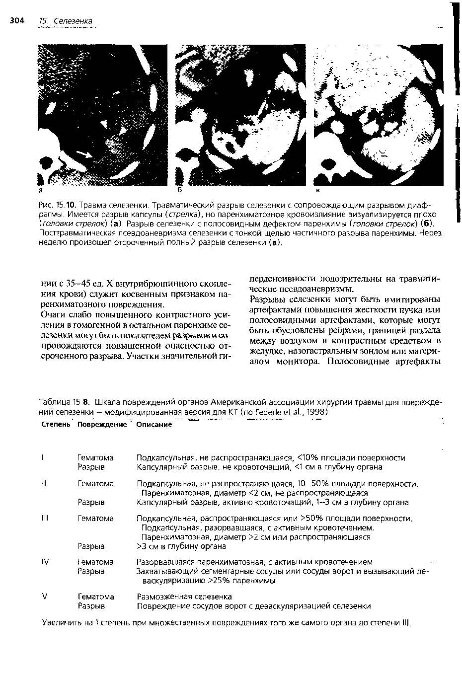 Рис. 15.10. Травма селезенки. Травматический разрыв селезенки с сопровождающим разрывом диаф-...