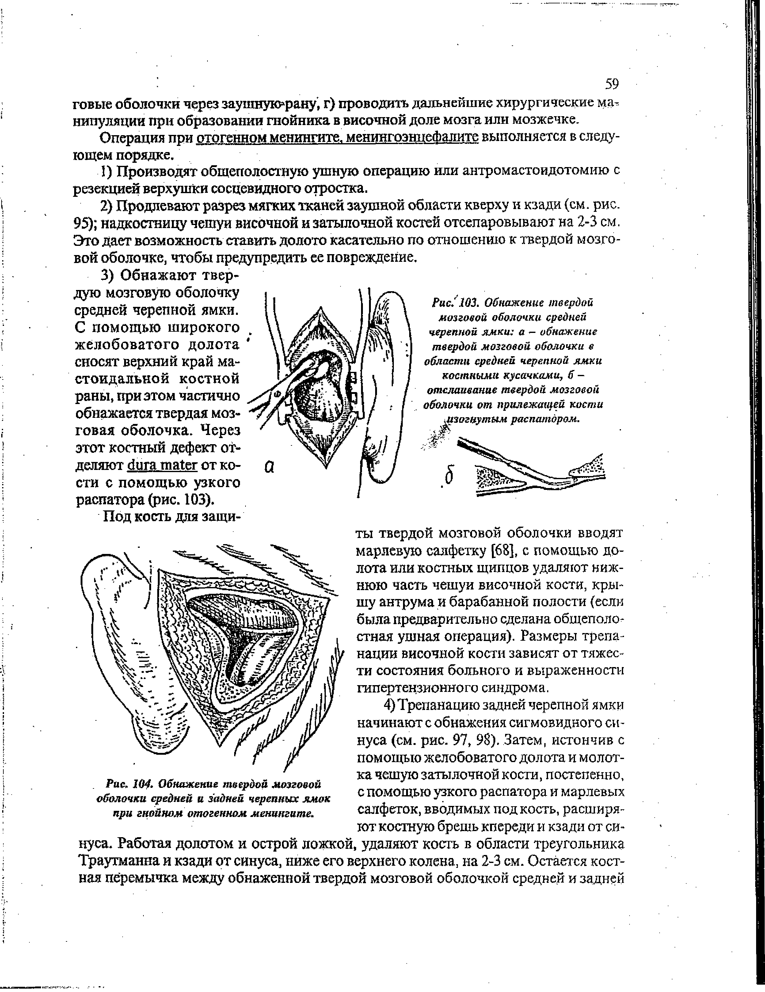 Рис. 104- Обнажение твердой мозговой оболочки средней и задней черепных ямок при гнойном отогенном менингите.