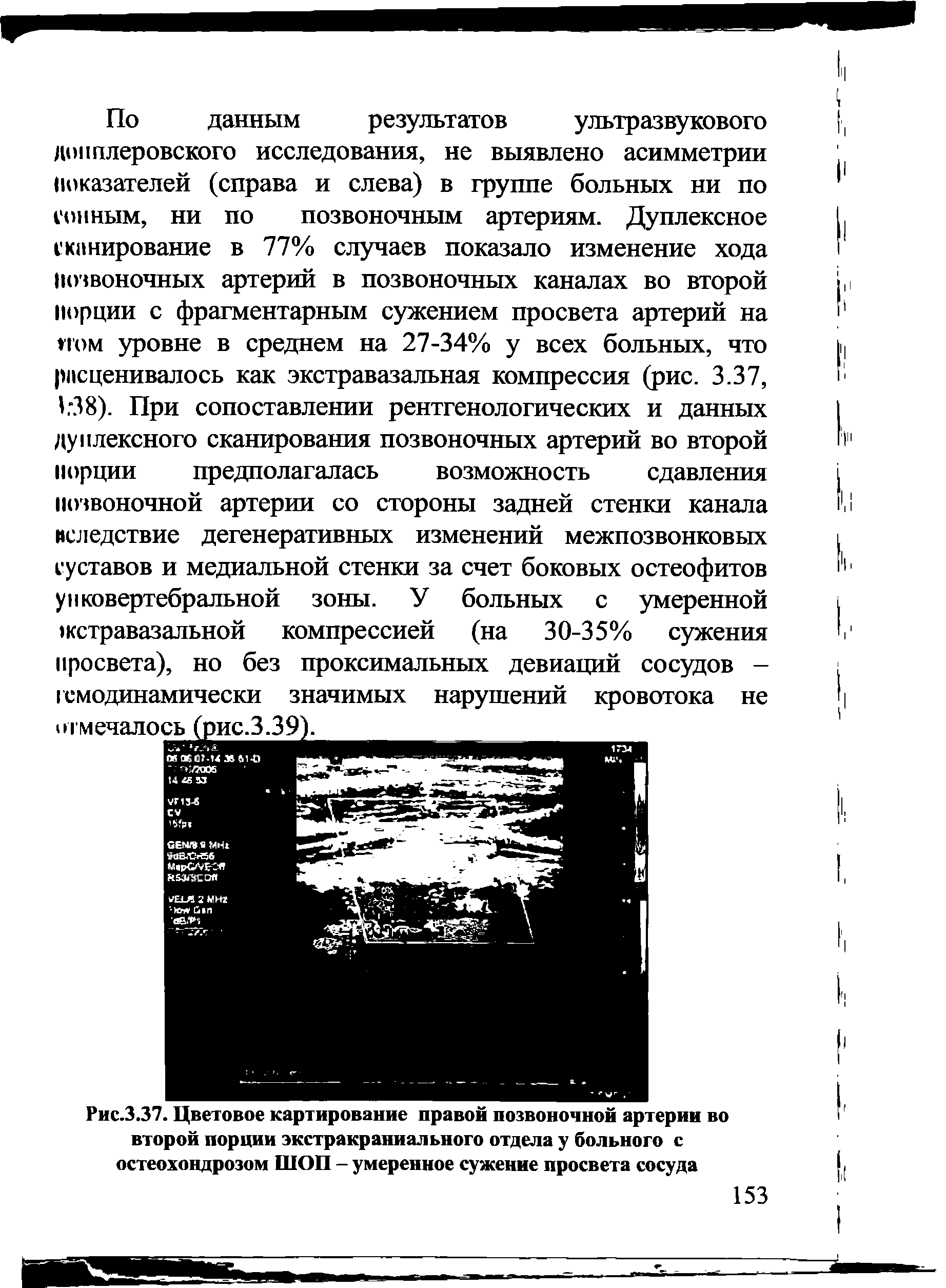 Рис.3.37. Цветовое картирование правой позвоночной артерии во второй порции экстракраниального отдела у больного с остеохондрозом ШОП - умеренное сужение просвета сосуда...