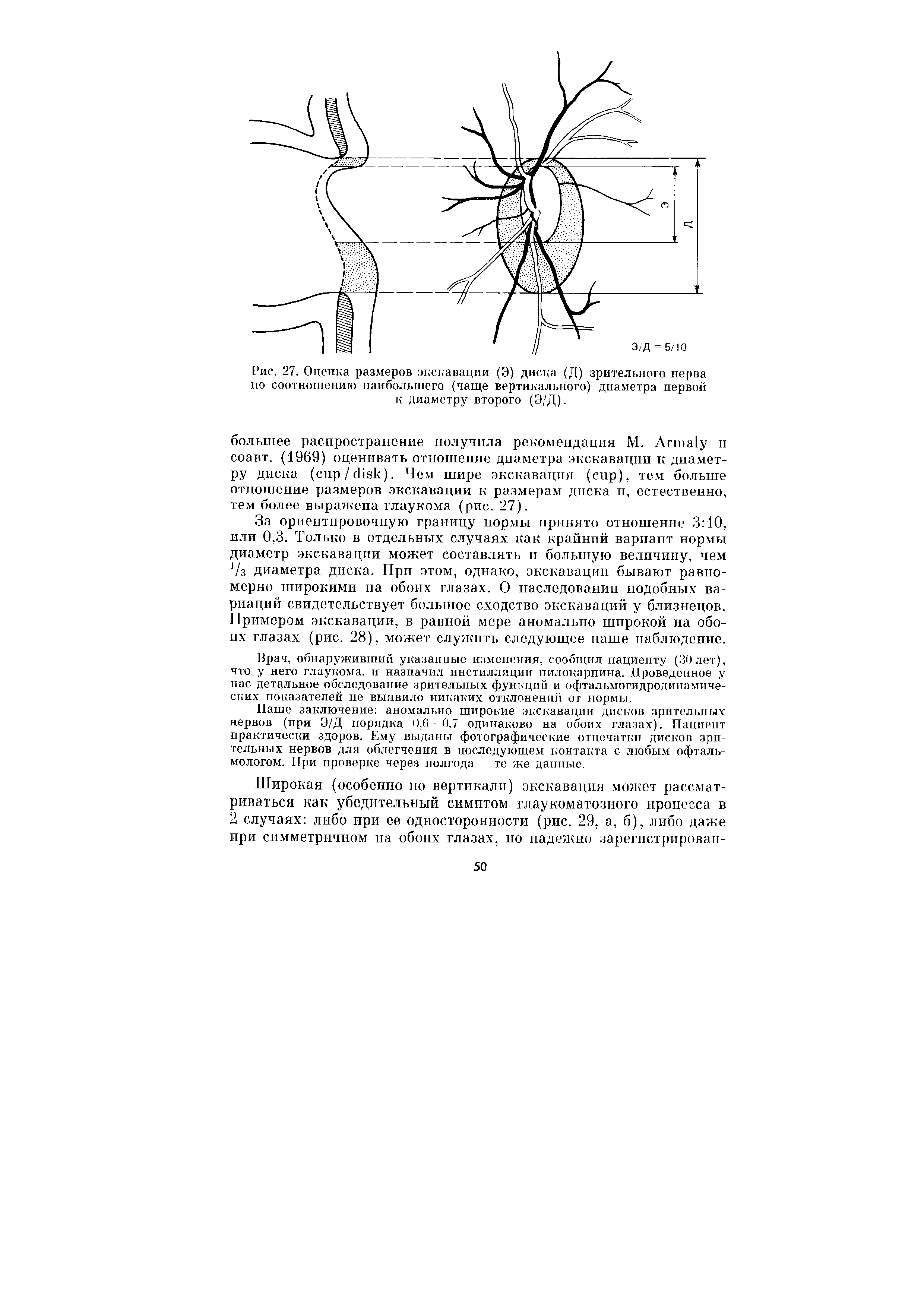 Рис. 27. Оценка размеров экскавации (Э) диска (Д) зрительного нерва по соотношению наибольшего (чаще вертикального) диаметра первой к диаметру второго (Э/Д).