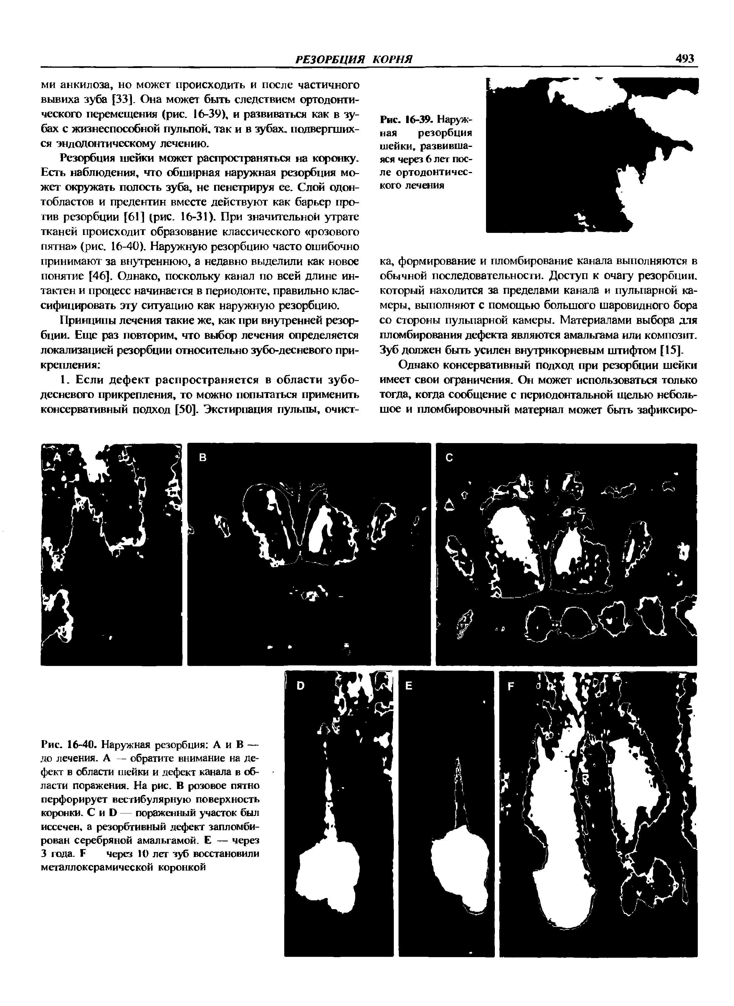 Рис. 16-40. Наружная резорбция А и В — до лечения. А — обратите внимание на дефект в области шейки и дефект канала в области поражения. На рис. В розовое пятно перфорирует вестибулярную поверхность коронки. С и I) — пораженный участок был иссечен, а резорбтивный дефект запломбирован серебряной амальгамой. Е — через 3 года. Е через 10 лет зуб восстановили металлокерамической коронкой...