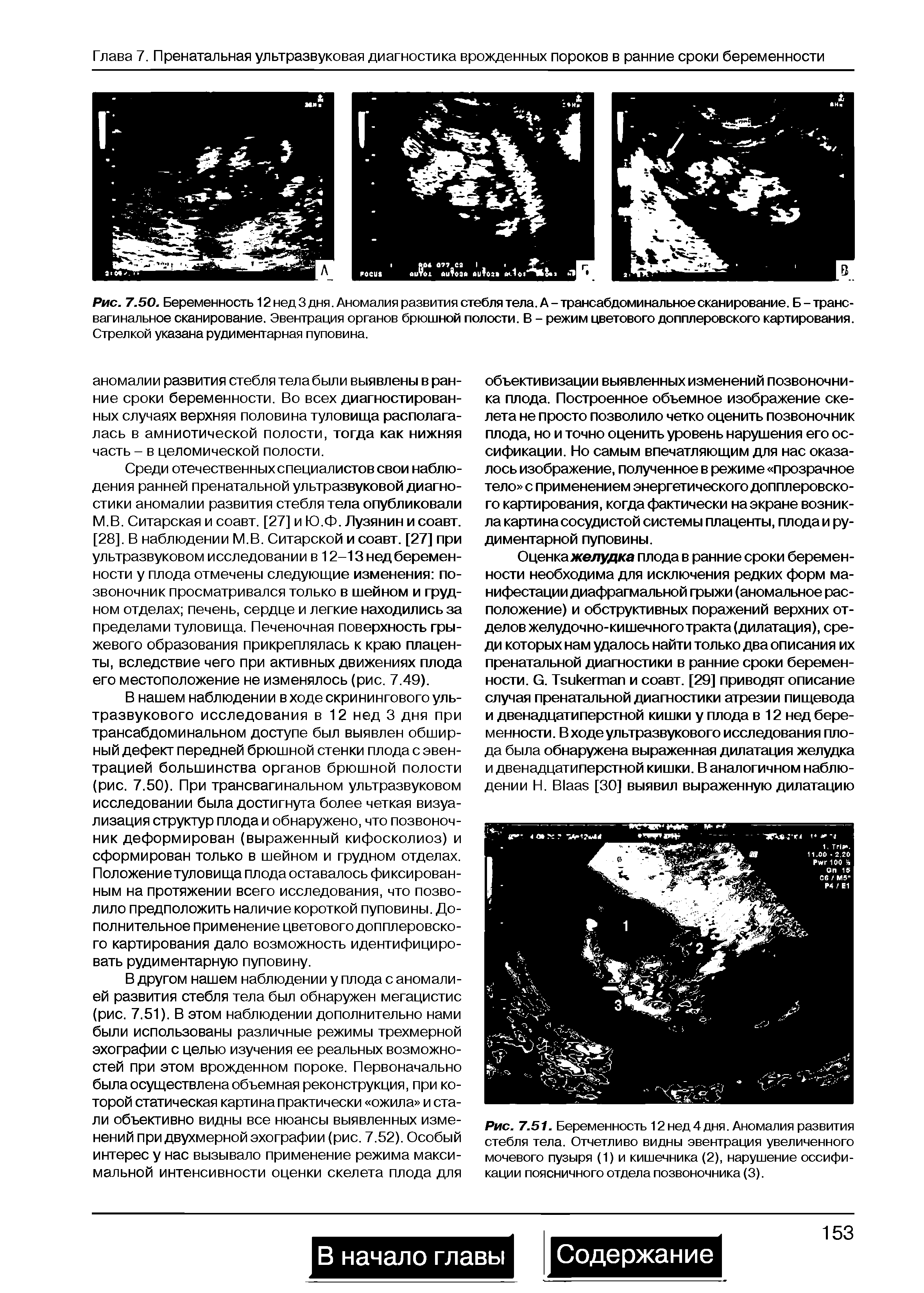 Рис. 7.50. Беременность 12 нед 3 дня. Аномалия развития стебля тела. А - трансабдоминальное сканирование. Б - трансвагинальное сканирование. Эвентрация органов брюшной полости. В - режим цветового допплеровского картирования. Стрелкой указана рудиментарная пуповина.