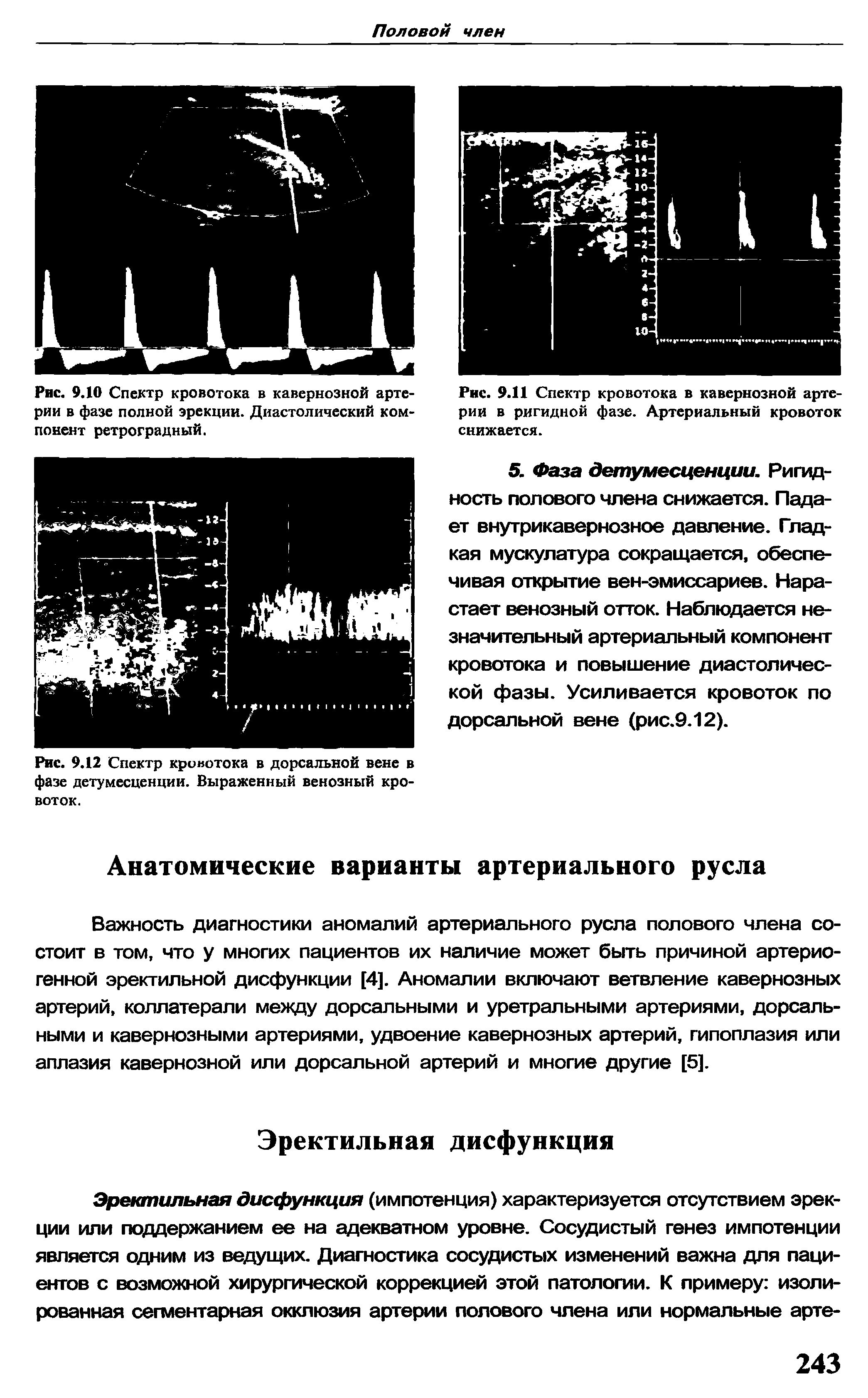 Рис. 9.12 Спектр кровотока в дорсальной вене в фазе детумесценции. Выраженный венозный кро-...