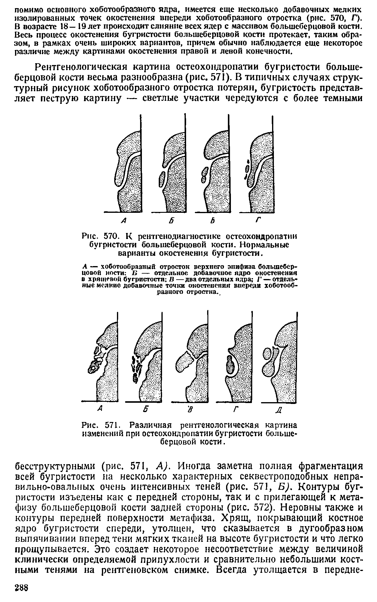 Рис. 571. Различная рентгенологическая картина изменений при остеохондропатии бугристости большеберцовой кости.