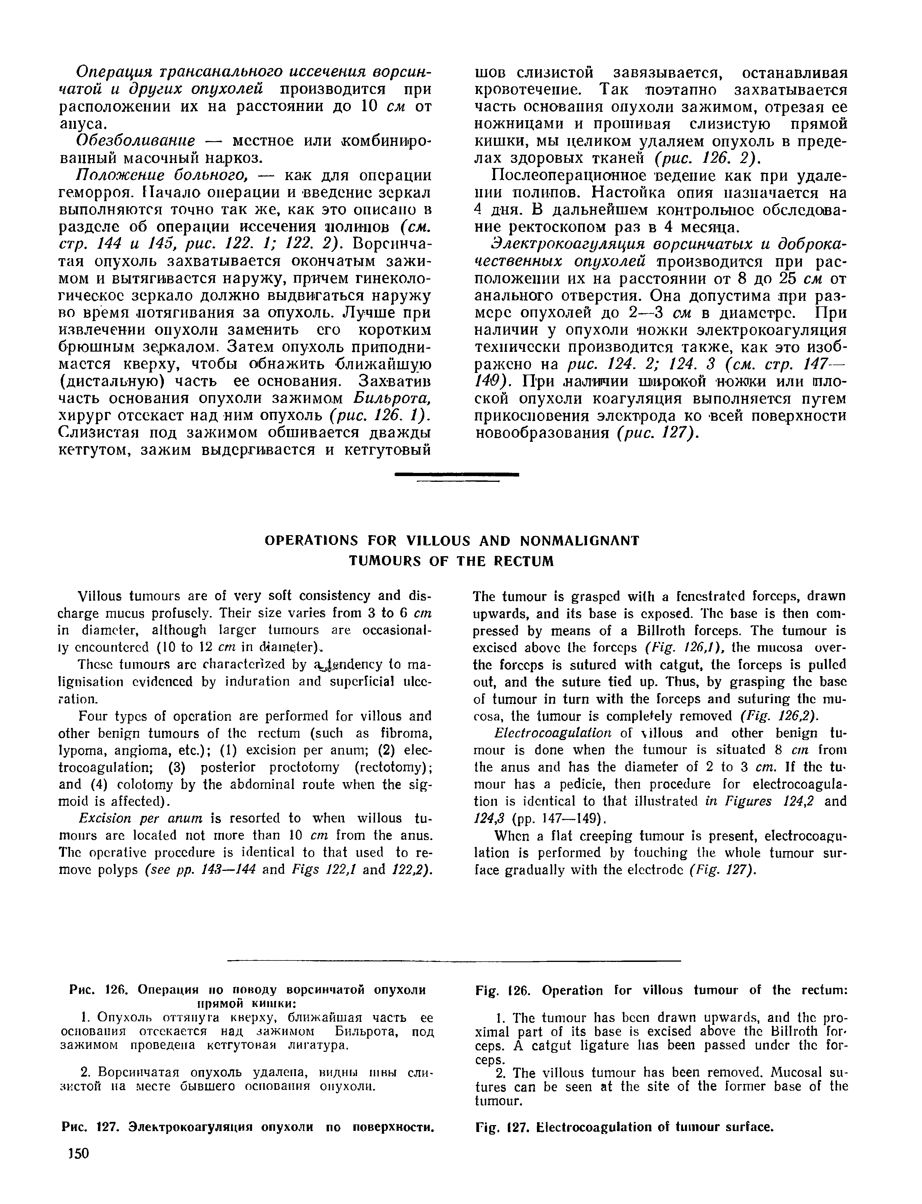 Рис. 126. Операция по поводу ворсинчатой опухоли прямой кишки ...