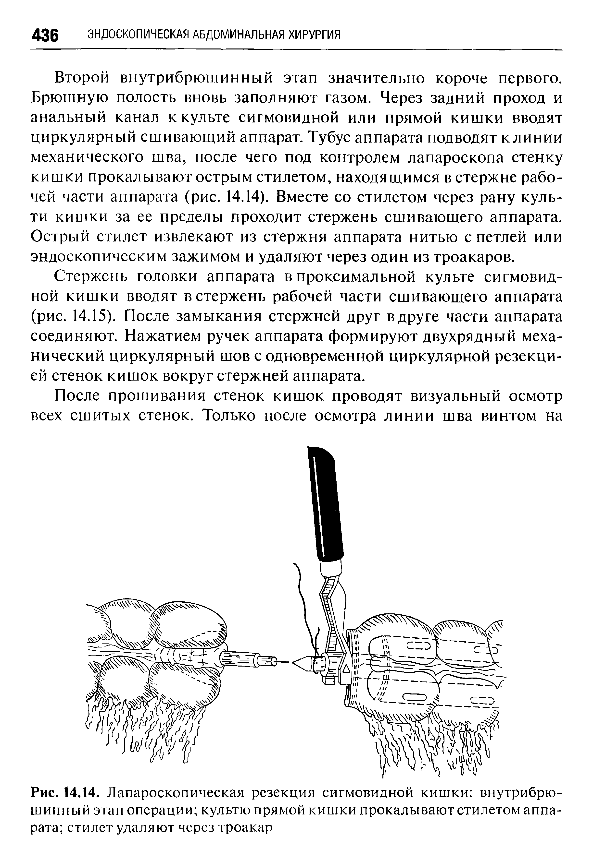 Рис. 14.14. Лапароскопическая резекция сигмовидной кишки внутрибрюшинный этап операции культю прямой кишки прокалывают стилетом аппарата стилет удаляют через троакар...