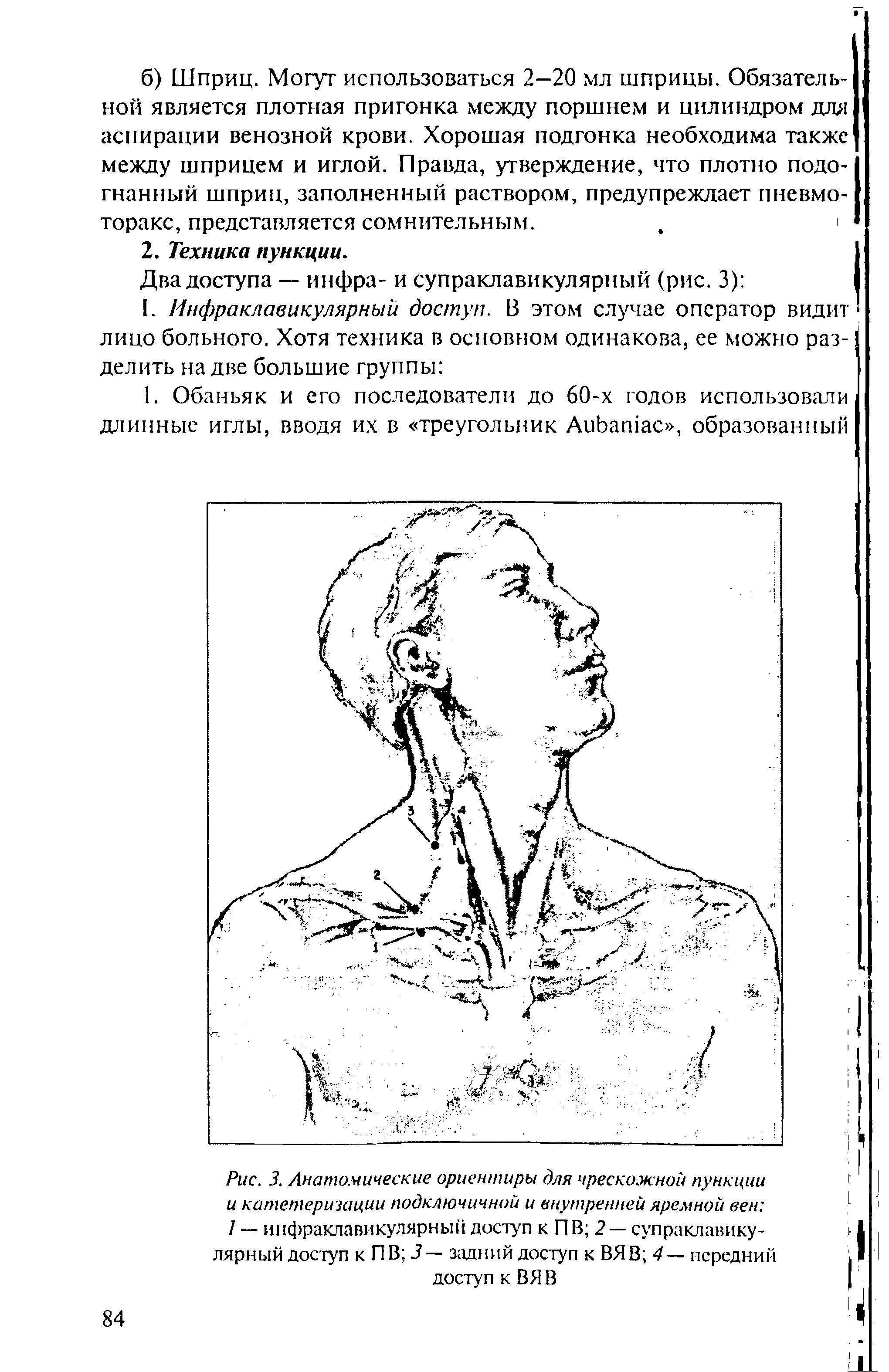 Рис. 3. Анатомические ориентиры для чрескожной пункции и катетеризации подключичной и внутренней яремной вен 1 — инфраклавикулярный доступ к П В 2 — супраклавикулярный доступ к ПВ 3— задний доступ к ВЯВ 4— передний доступ к ВЯ В...