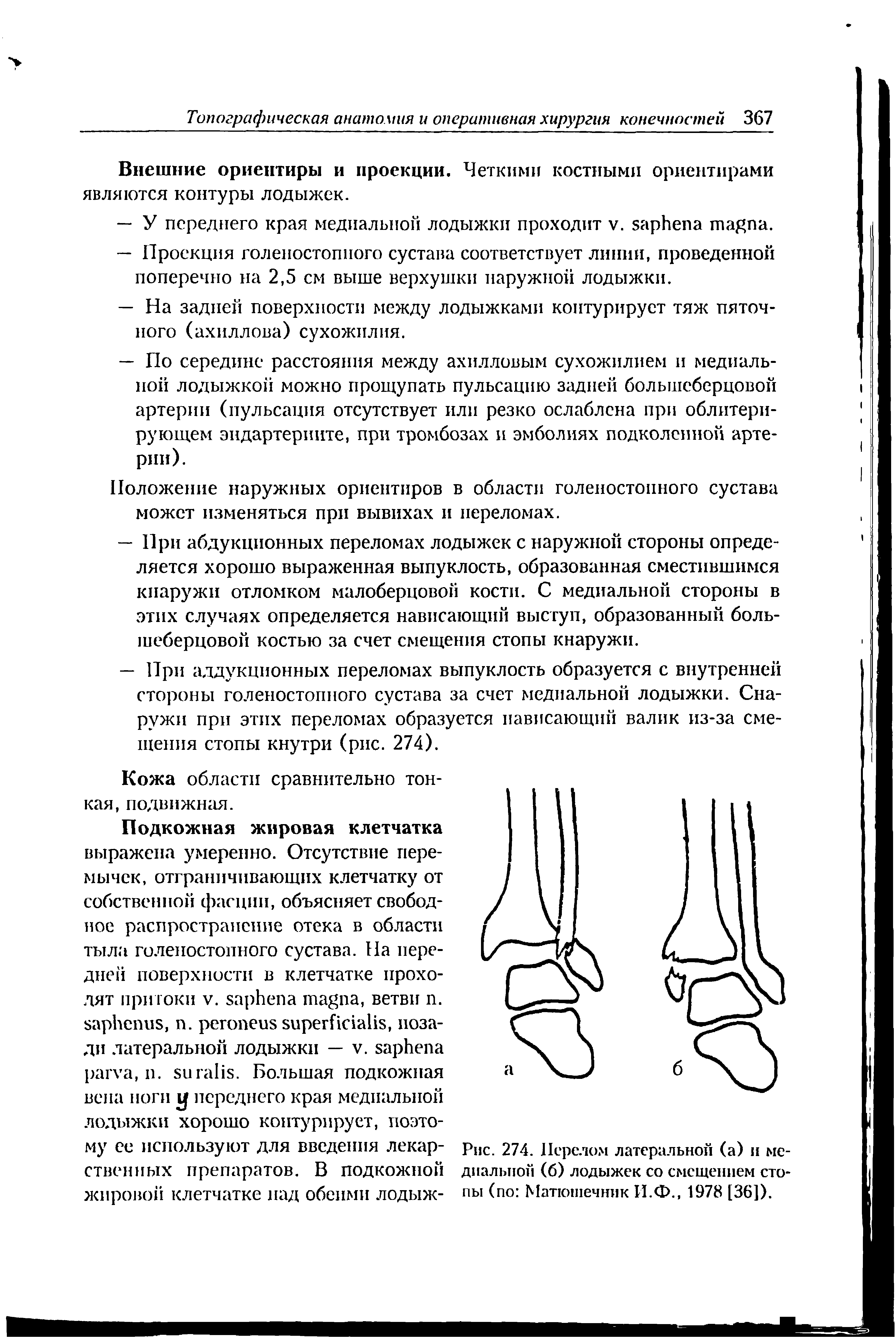 Рис. 274. Перелом латеральной (а) и медиальной (б) лодыжек со смещением стопы (по Матюшечник И.Ф., 1978 [36]).