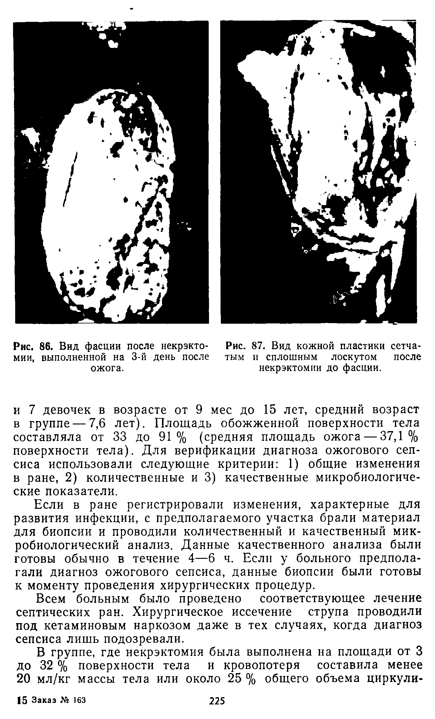 Рис. 87. Вид кожной пластики сетчатым и сплошным лоскутом после некрэктомии до фасции.