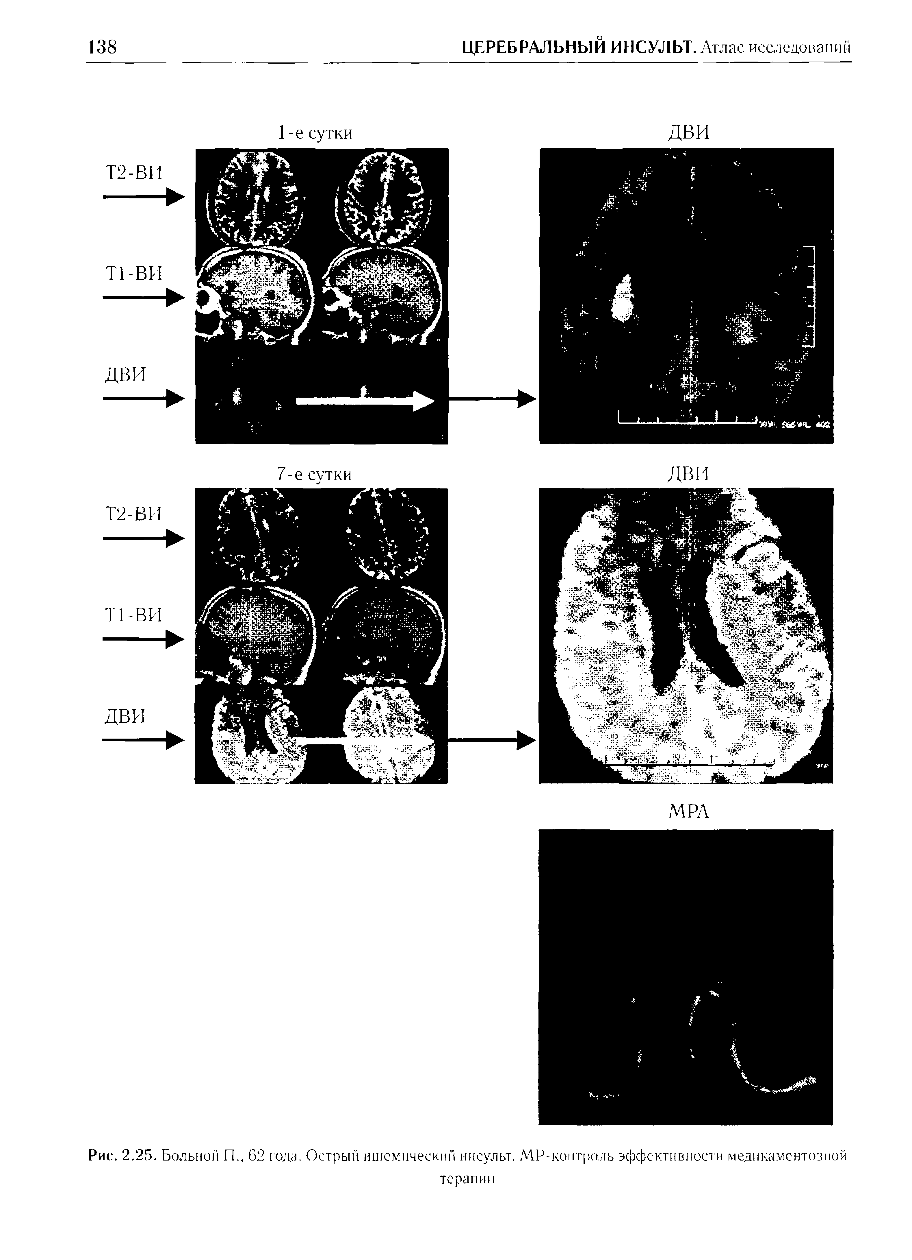 Рис. 2.25. Больной П., 62 года. Острый ишемический инсульт. МР-контроль эффективности медикаментозной терапии...