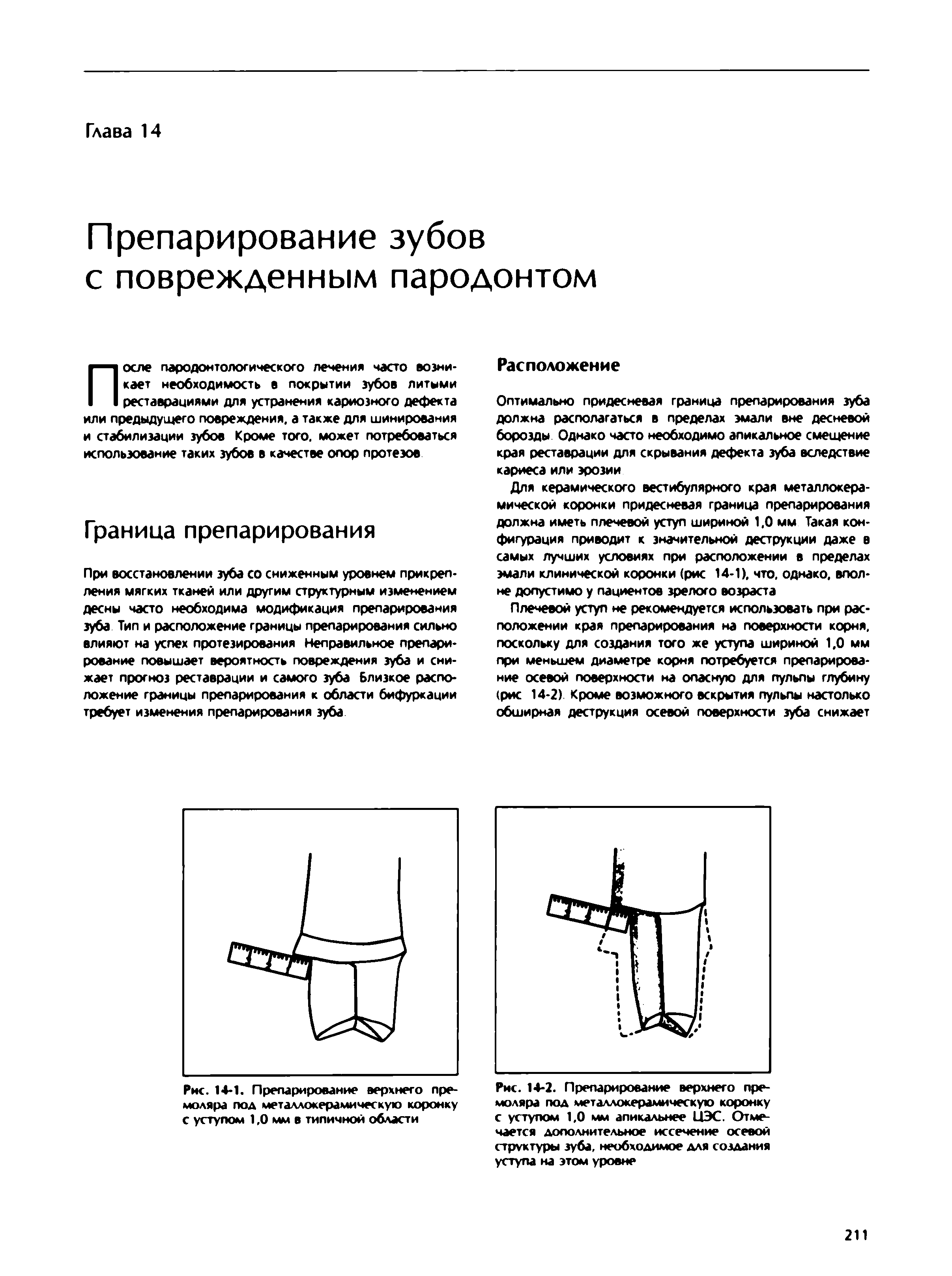 Рис. 14-2. Препарирование верхнего премоляра под металлокерамическую коронку с уступом 1,0 мм апикальнее ЦЭС. Отмечается дополнительное иссечение осевой структуры зуба, необходимое для создания уступа на этом уровне...