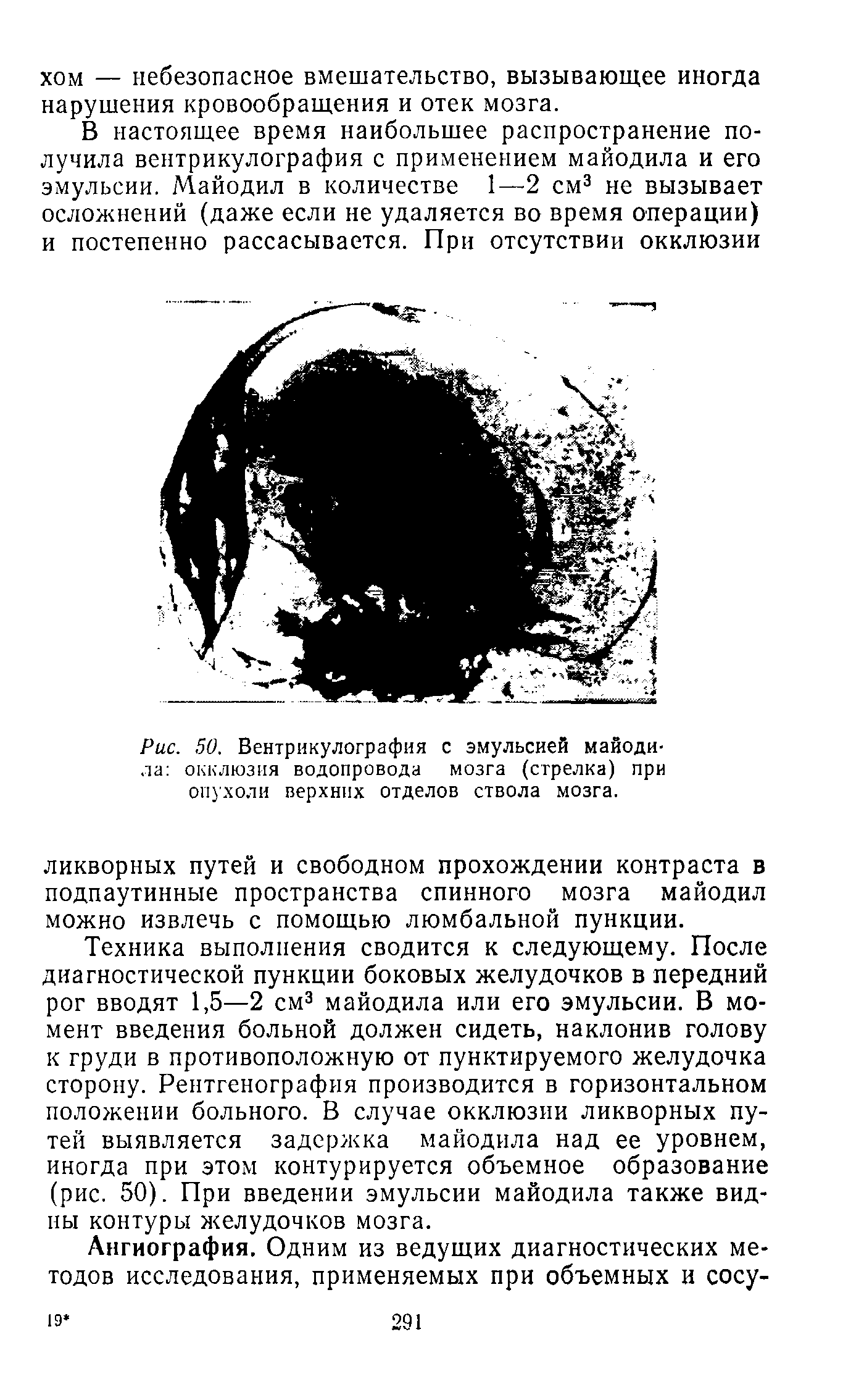 Рис. 50. Вентрикулография с эмульсией майодила окклюзия водопровода мозга (стрелка) при опухоли верхних отделов ствола мозга.