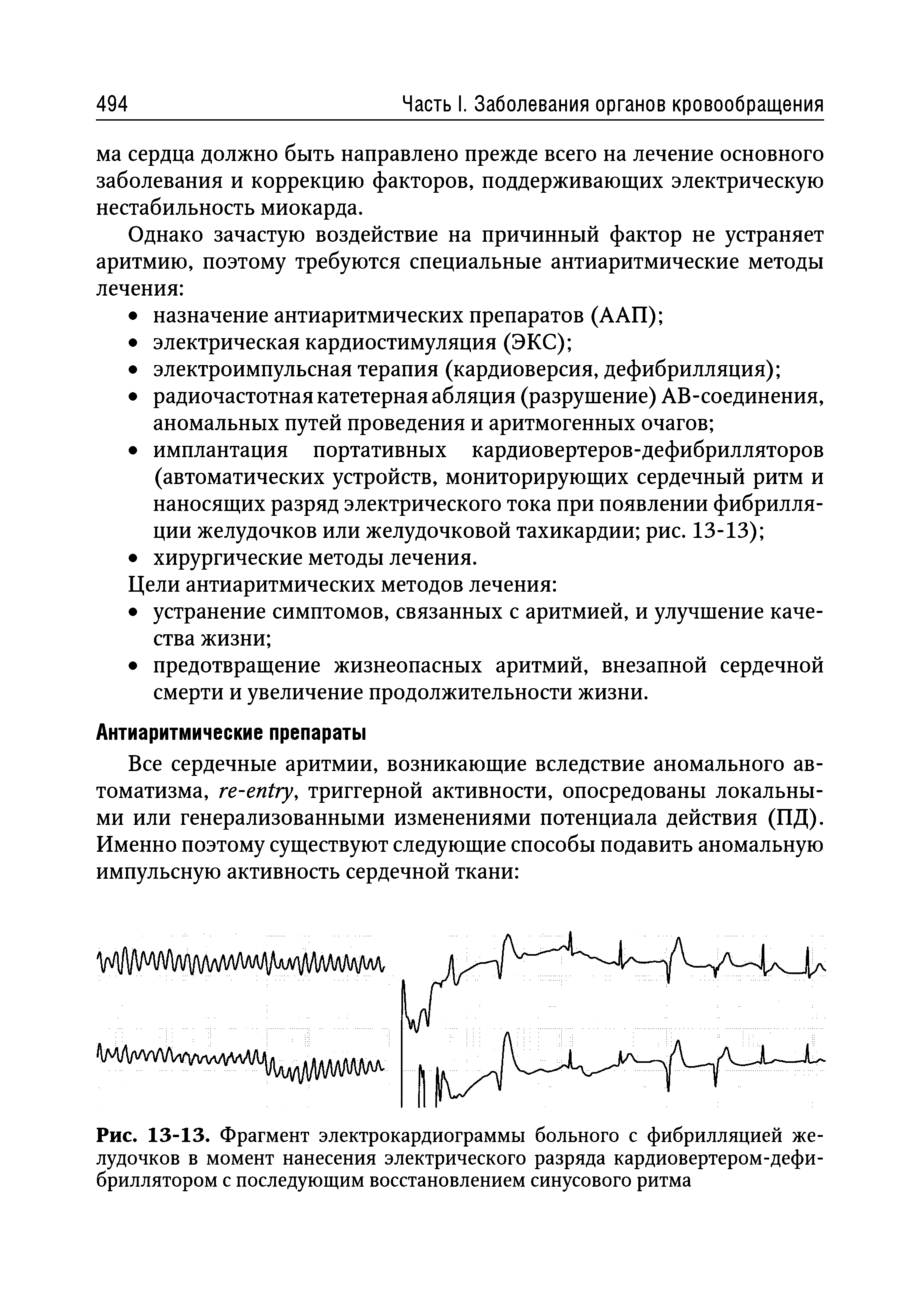 Рис. 13-13. Фрагмент электрокардиограммы больного с фибрилляцией желудочков в момент нанесения электрического разряда кардиовертером-дефибриллятором с последующим восстановлением синусового ритма...