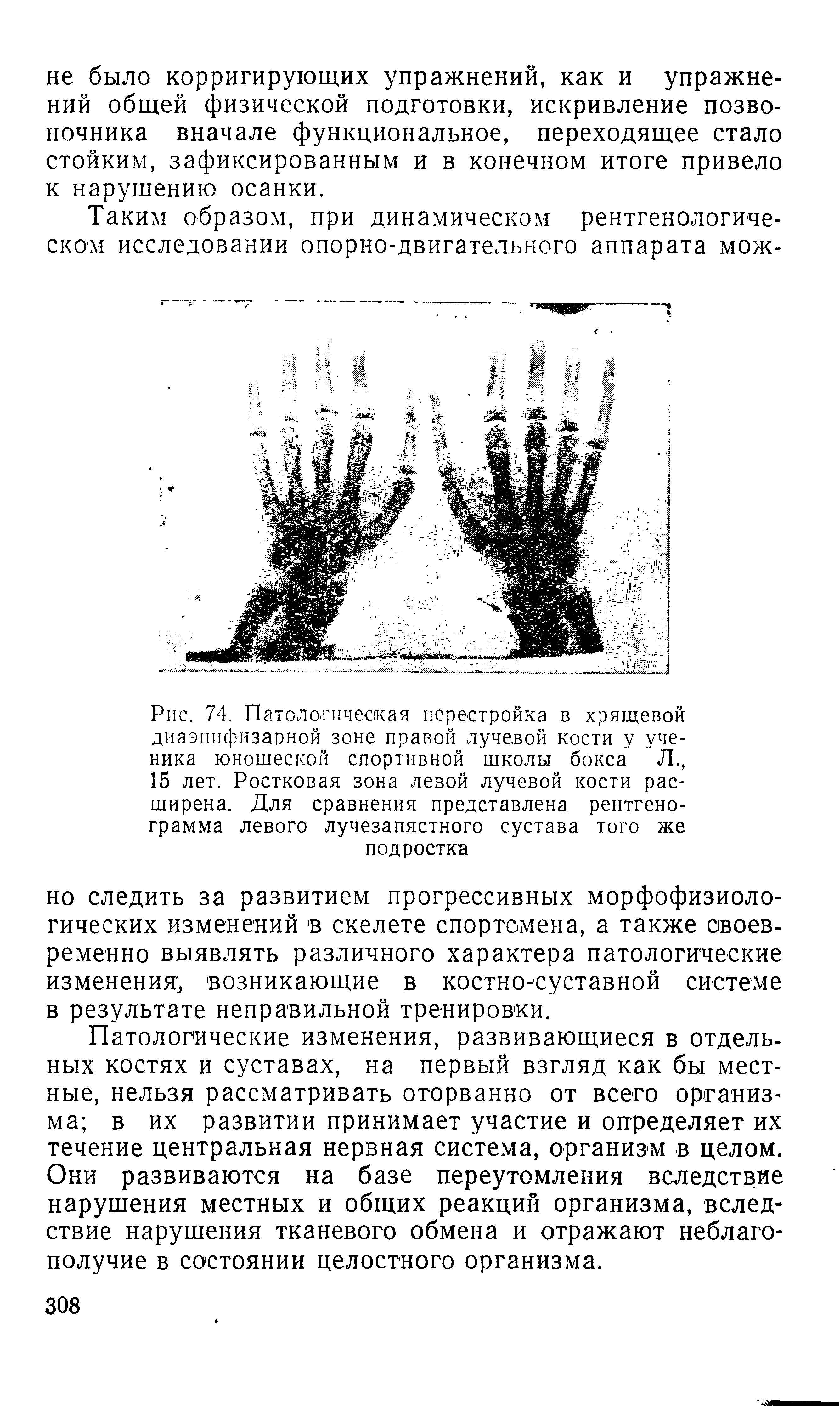 Рис. 74. Патологическая перестройка в хрящевой диаэппфизарной зоне правой лучевой кости у ученика юношеской спортивной школы бокса Л., 15 лет. Ростковая зона левой лучевой кости расширена. Для сравнения представлена рентгенограмма левого лучезапястного сустава того же подростка...