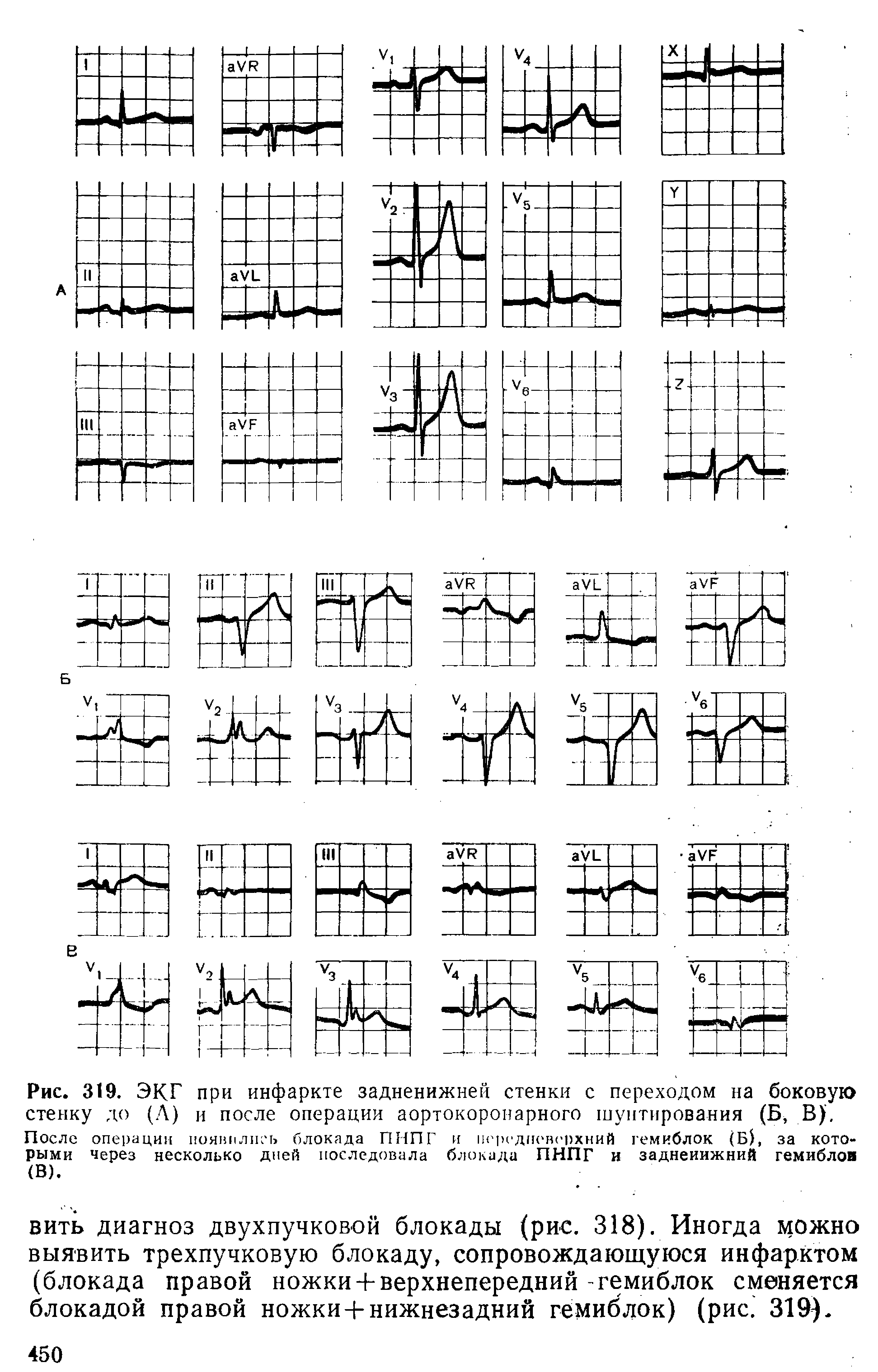 Рис. 319. ЭКГ при инфаркте задненижней стенки с переходом на боковую стенку до (Л) и после операции аортокоронарного шунтирования (Б, В), После операции появились блокада ПНПГ и 1П н,днов( 1)хний гемиблок (Б, за которыми через несколько дней последовала блокада ПНПГ и заднеиижний гемиблов (В).
