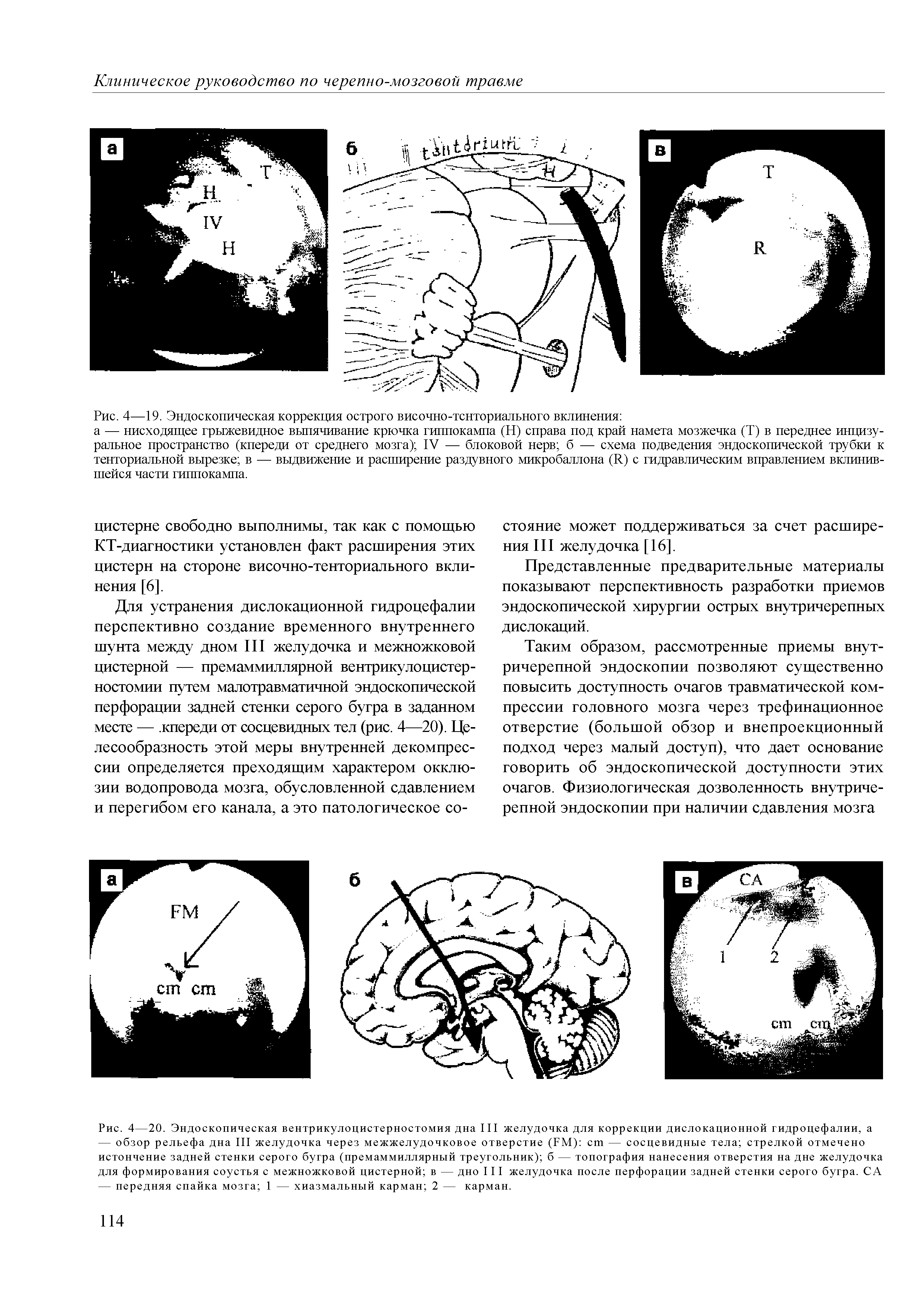 Рис. 4—20. Эндоскопическая вентрикулоцистерностомия дна III желудочка для коррекции дислокационной гидроцефалии, а...