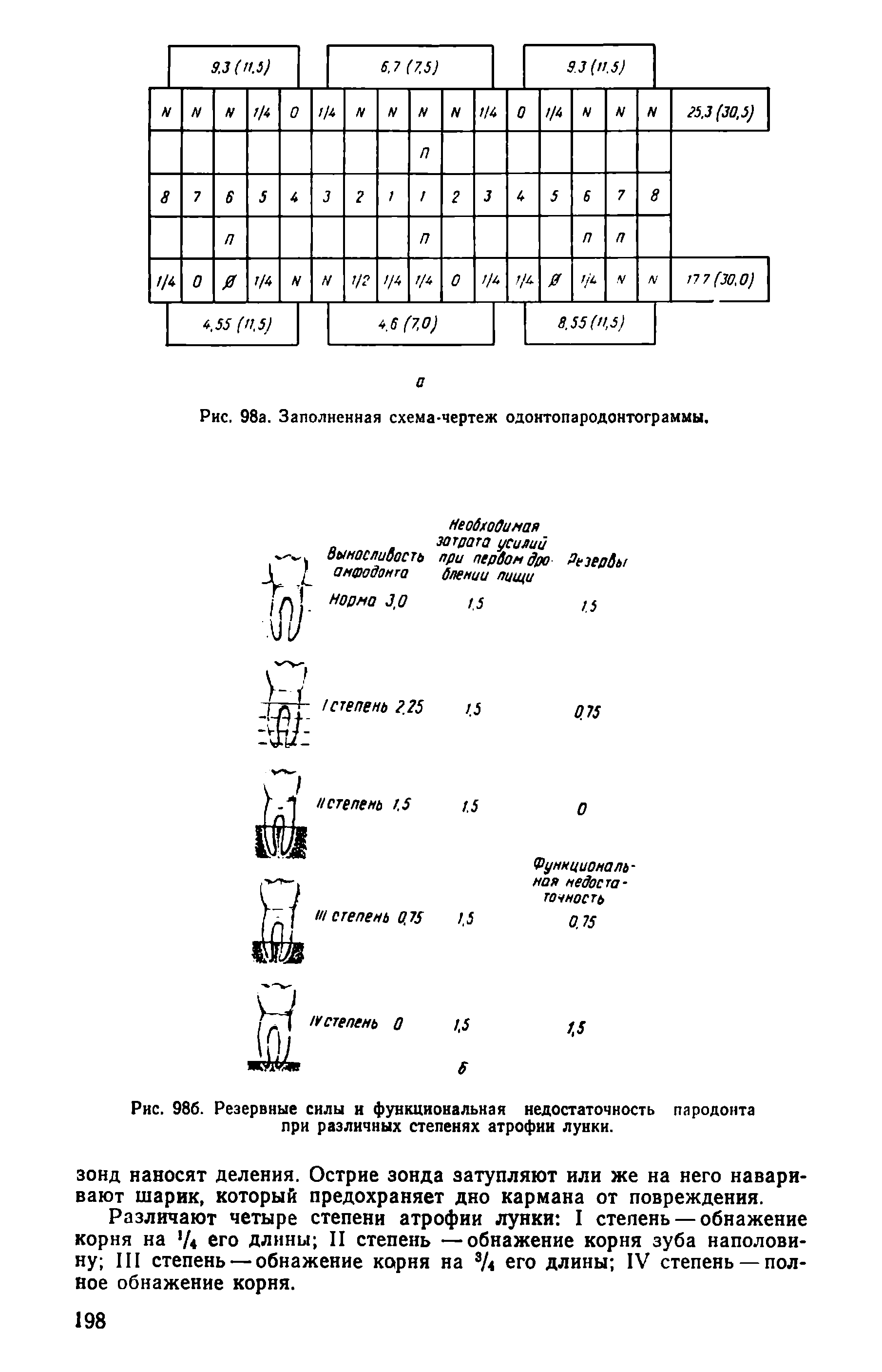 Рис. 986. Резервные силы и функциональная недостаточность пародонта при различных степенях атрофии лунки.