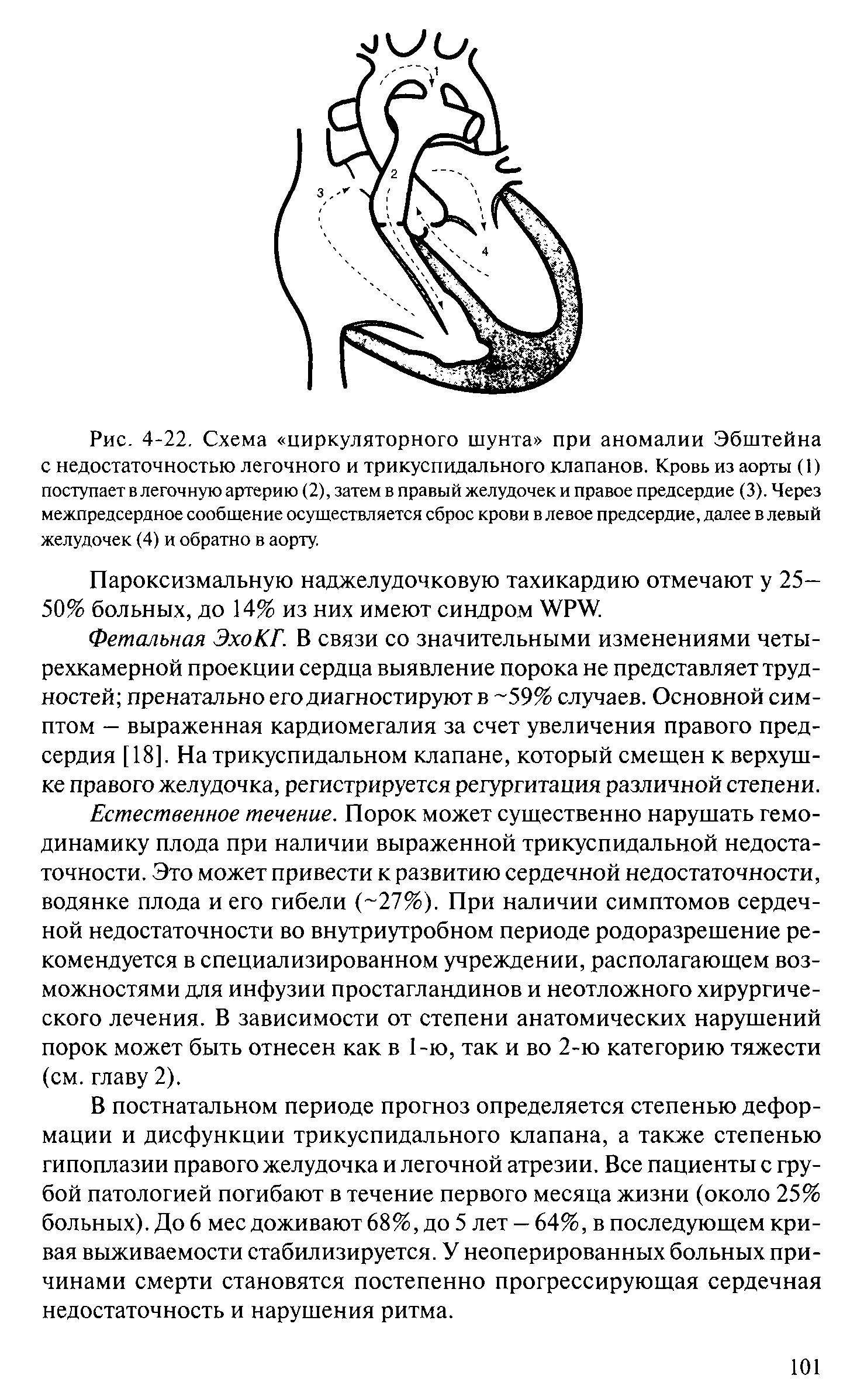 Рис. 4-22. Схема циркуляторного с недостаточностью легочного и трикуспидального клапанов. Кровь из аорты (1) поступает в легочную артерию (2), затем в правый желудочек и правое предсердие (3). Через межпредсердное сообщение осуществляется сброс крови в левое предсердие, далее в левый желудочек (4) и обратно в аорту.