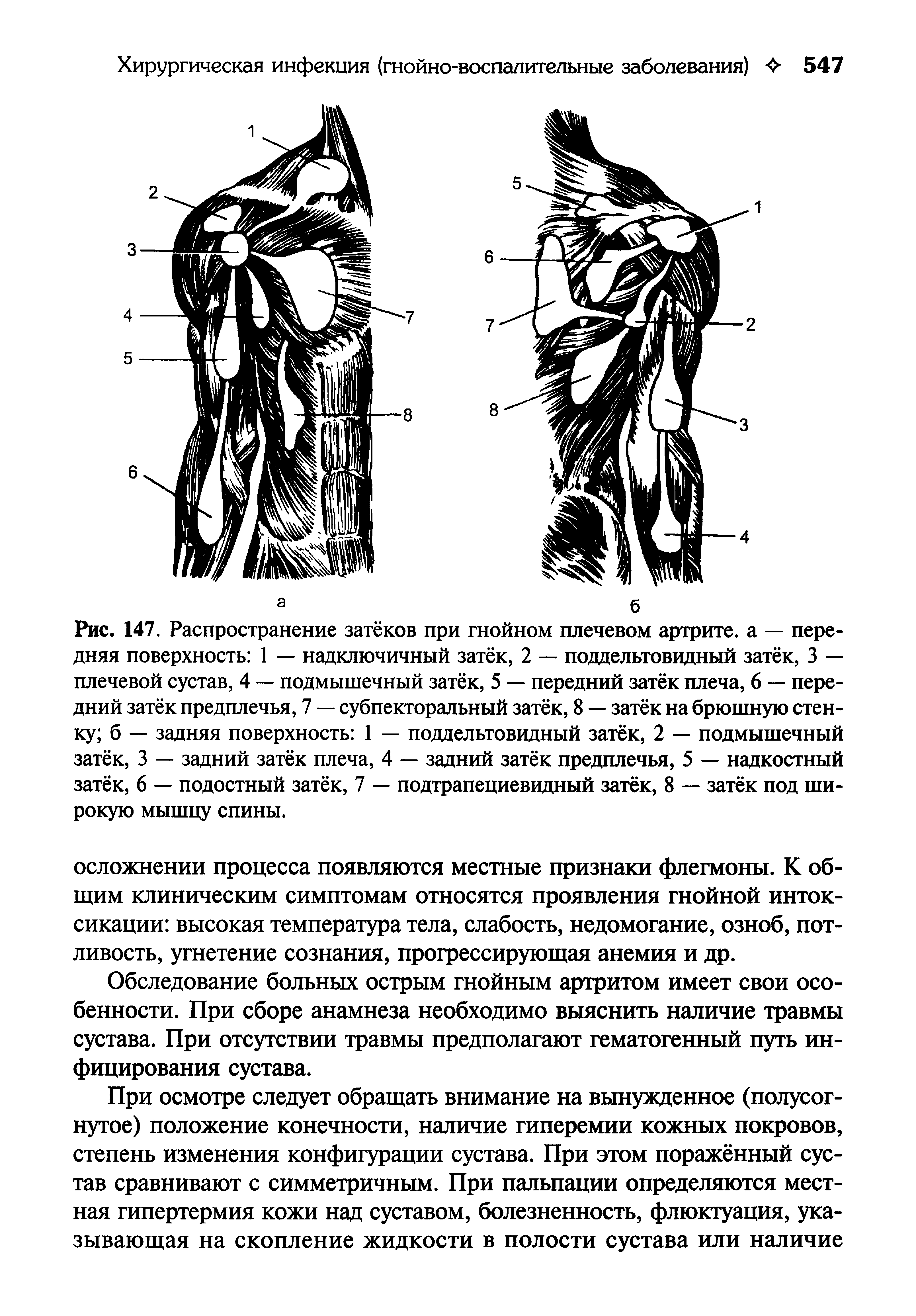 Рис. 147. Распространение затёков при гнойном плечевом артрите, а — передняя поверхность 1 — надключичный затёк, 2 — поддельтовидный затёк, 3 — плечевой сустав, 4 — подмышечный затёк, 5 — передний затёк плеча, 6 — передний затёк предплечья, 7 — субпекторальный затёк, 8 — затёк на брюшную стенку б — задняя поверхность 1 — поддельтовидный затёк, 2 — подмышечный затёк, 3 — задний затёк плеча, 4 — задний затёк предплечья, 5 — надкостный затёк, 6 — подостный затёк, 7 — подтрапециевидный затёк, 8 — затёк под широкую мышцу спины.