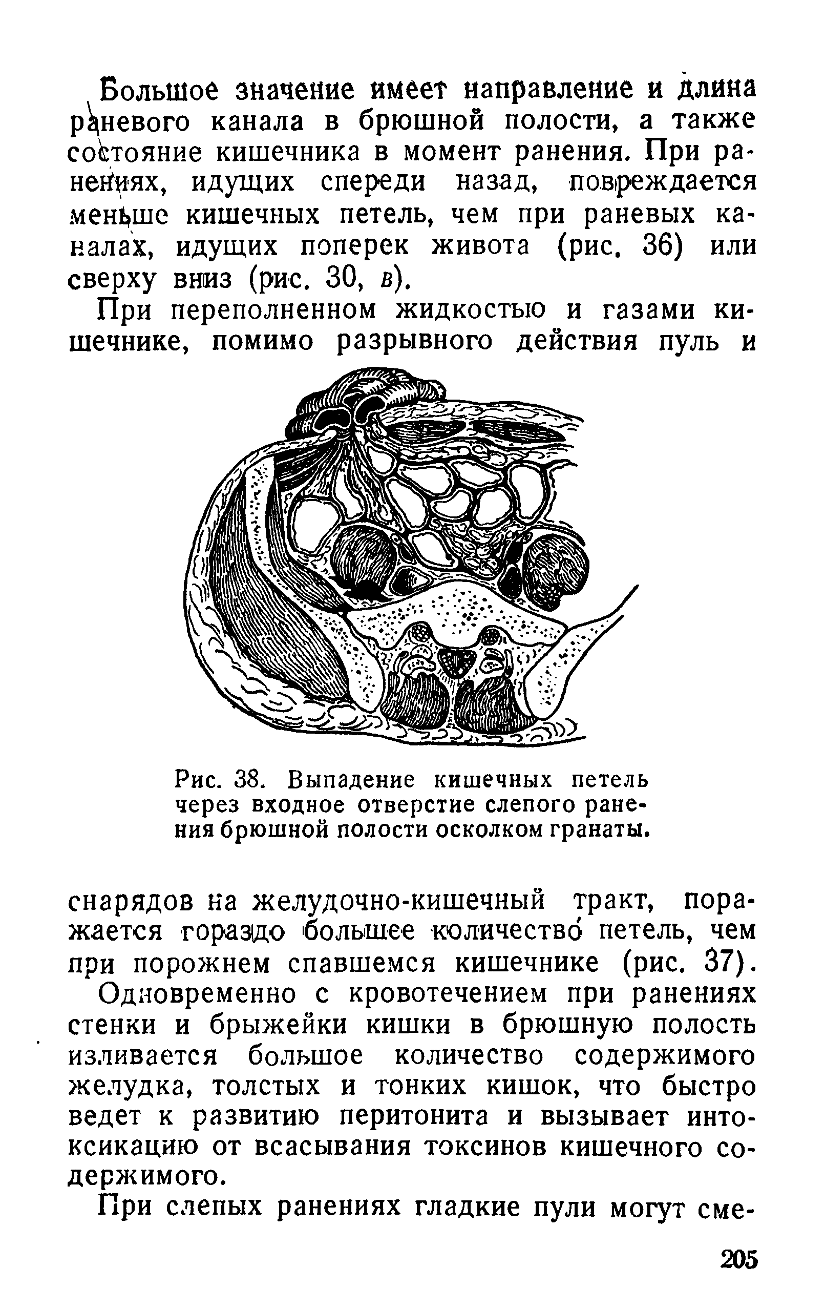 Рис. 38. Выпадение кишечных петель через входное отверстие слепого ранения брюшной полости осколком гранаты.