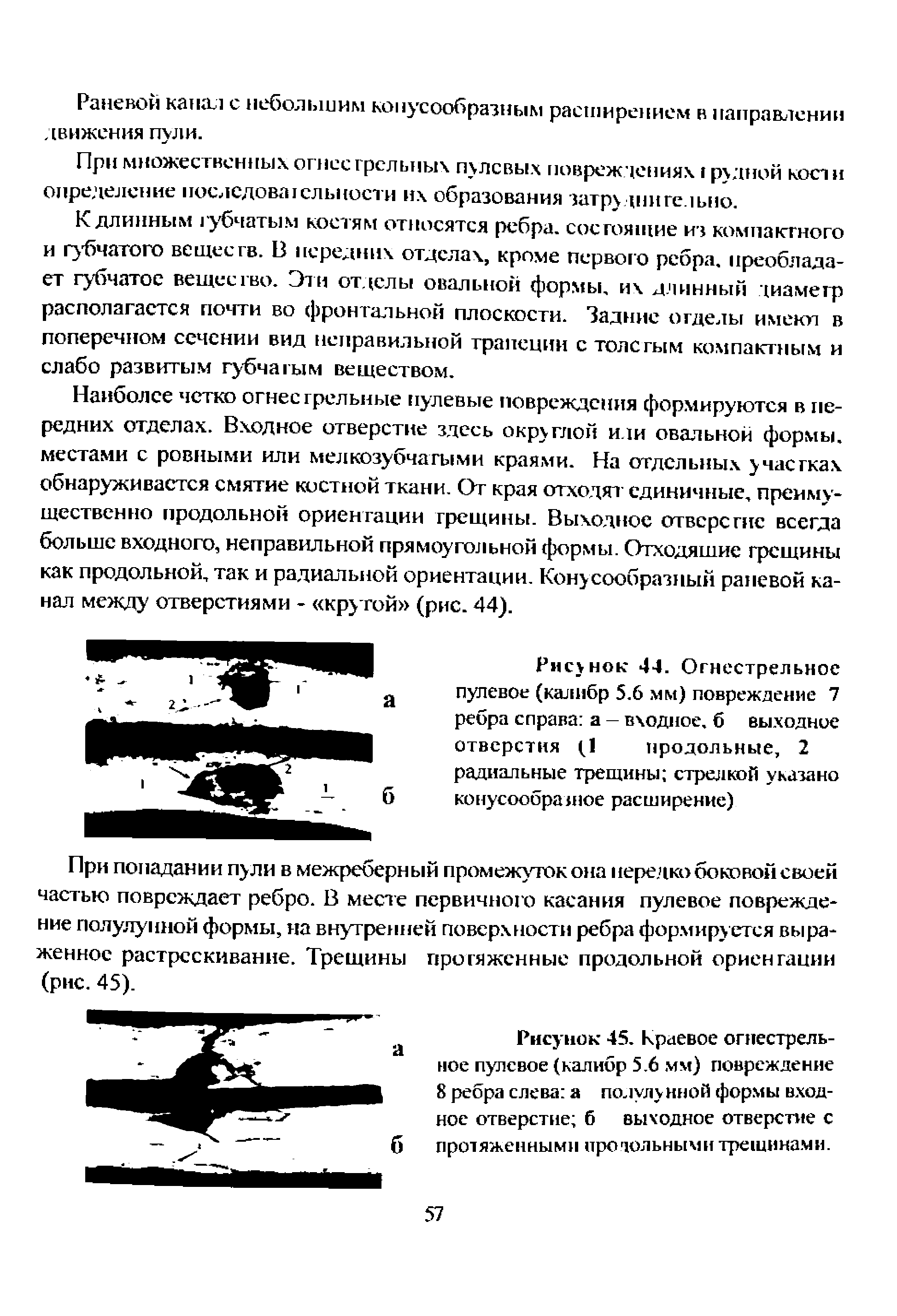 Рисунок 45. Краевое огнестрельное пулевое (калибр 5.6 мм) повреждение 8 ребра слева подулу иной формы входное отверстие б выходное отверстие с протяженными про зольным и трещинами.