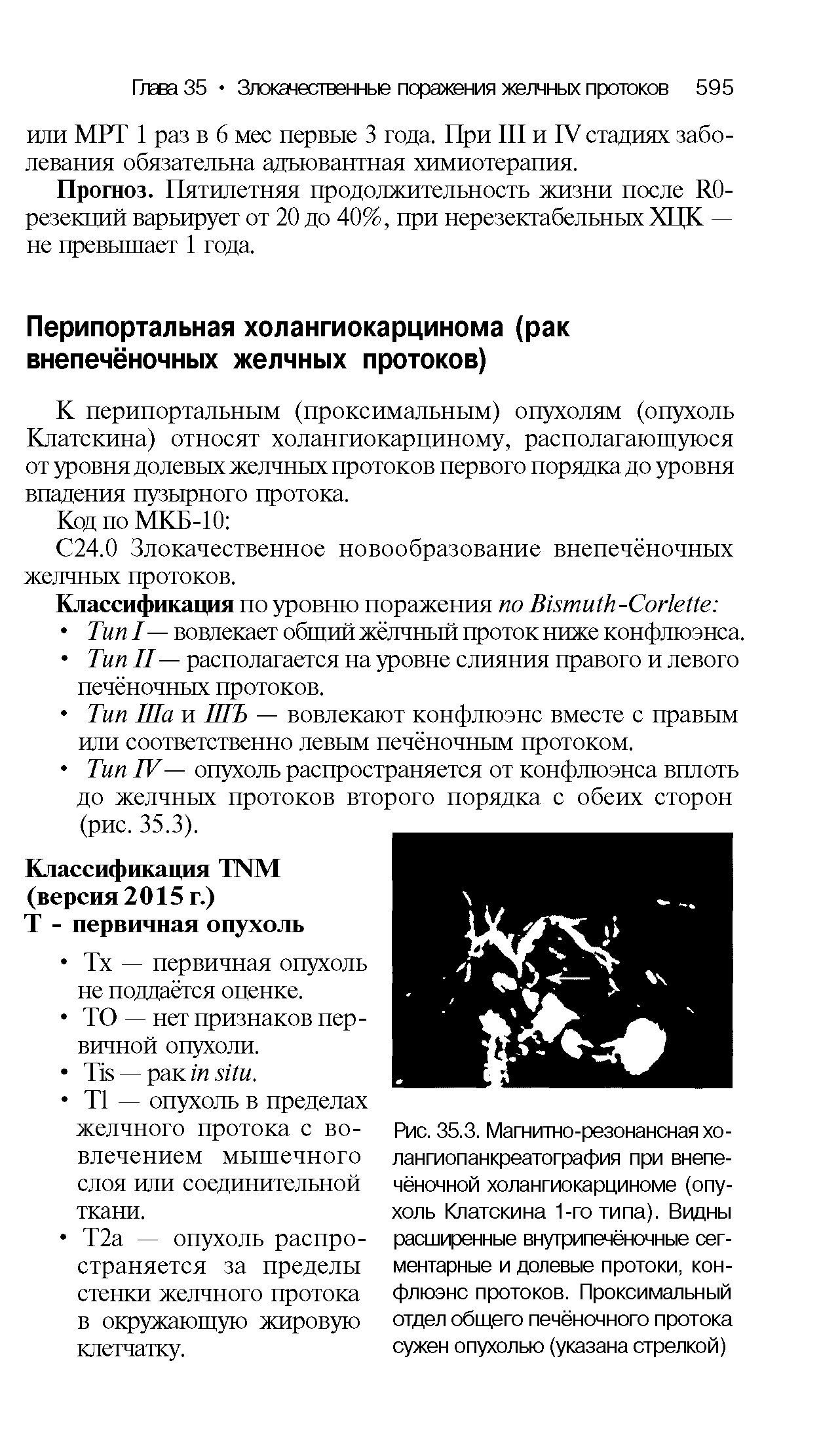 Рис. 35.3. Магнитно-резонансная холангиопанкреатография при внепечёночной холангиокарциноме (опухоль Клатскина 1-го типа). Видны расширенные внутрипечёночные сегментарные и долевые протоки, конфлюэнс протоков. Проксимальный отдел общего печёночного протока сужен опухолью (указана стрелкой)...