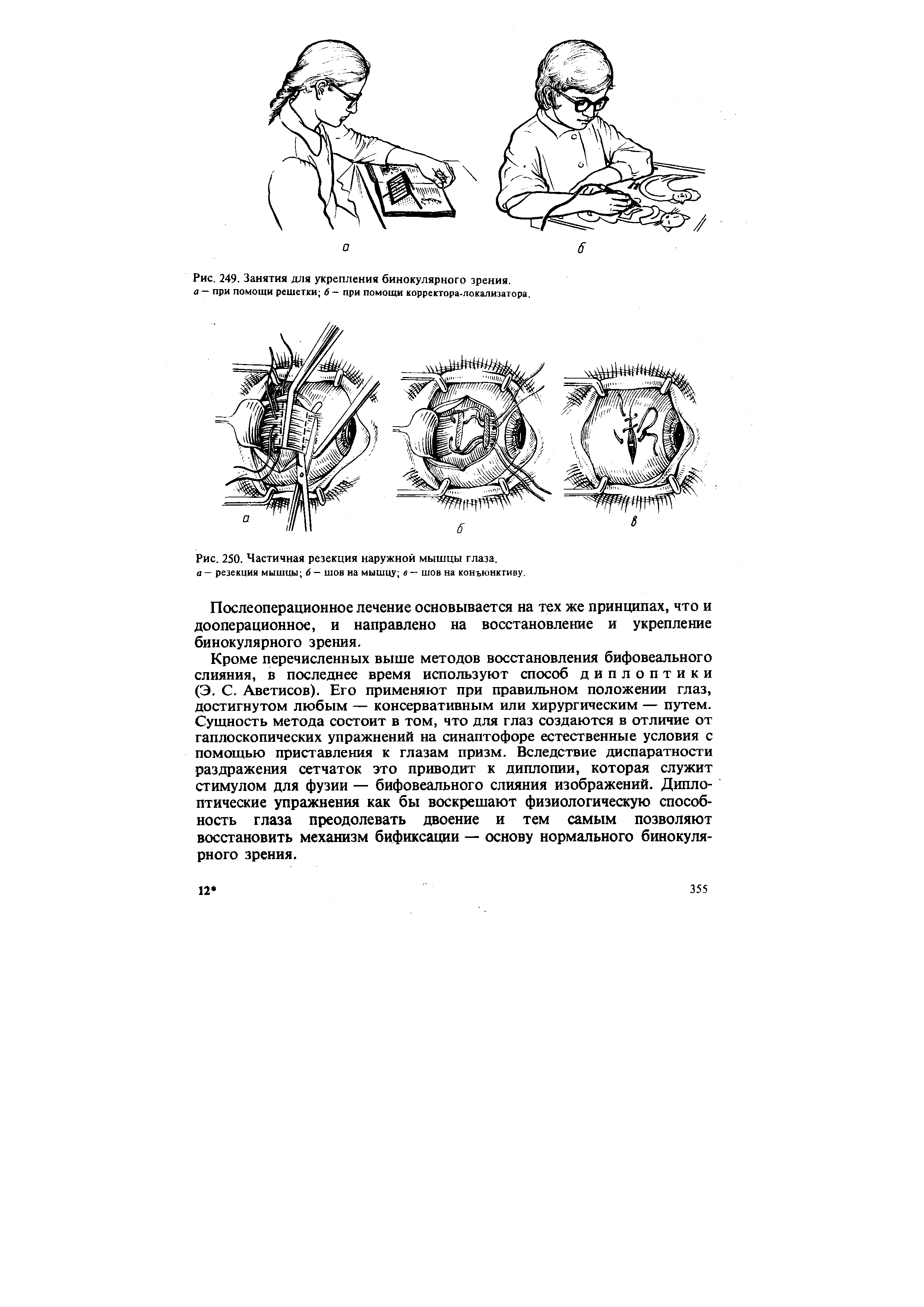 Рис. 250. Частичная резекция наружной мышцы глаза. а — резекция мышцы 6 — шов на мышцу в — шов на конъюнктиву.