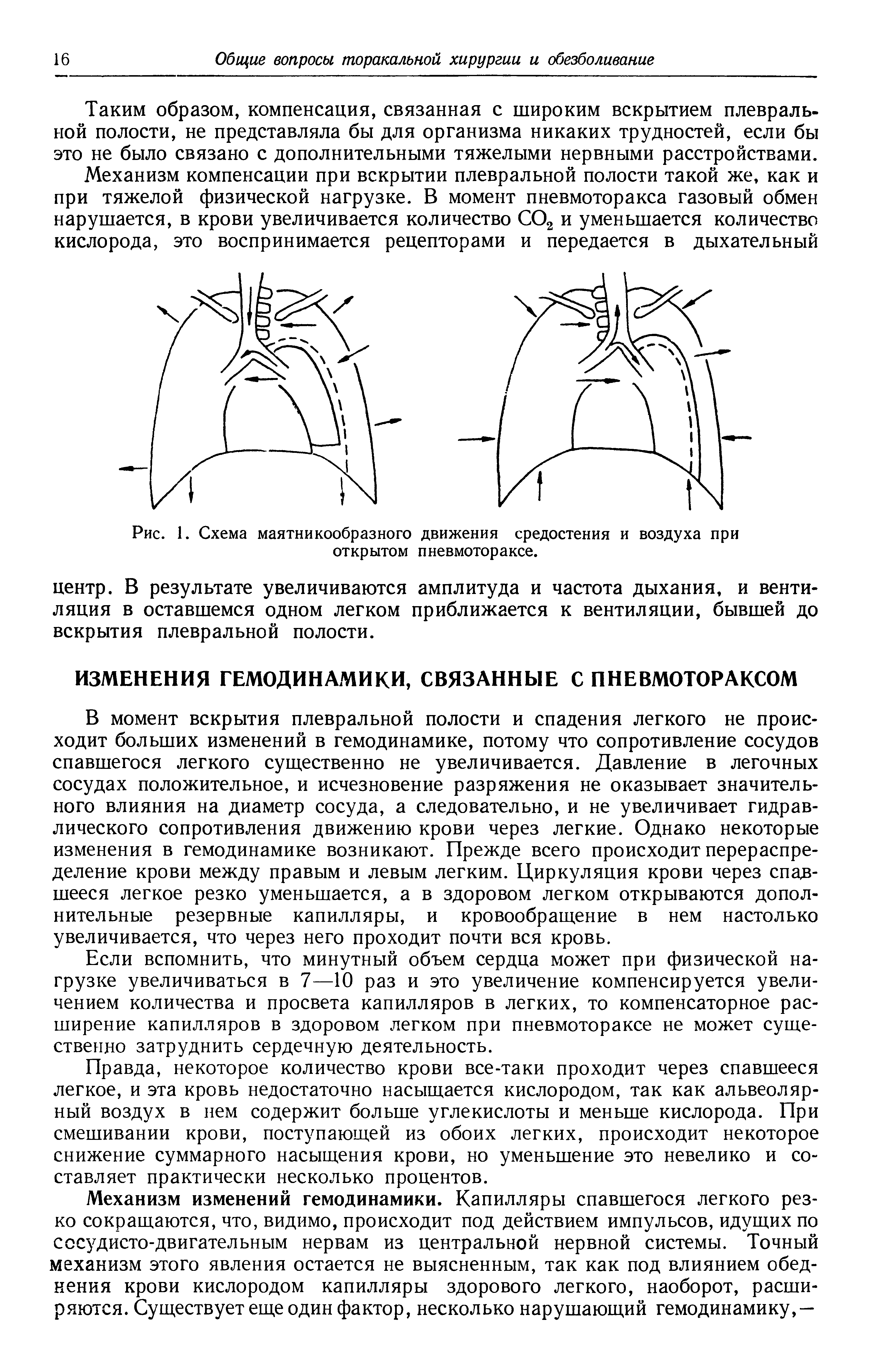 Рис. 1. Схема маятникообразного движения средостения и воздуха при открытом пневмотораксе.