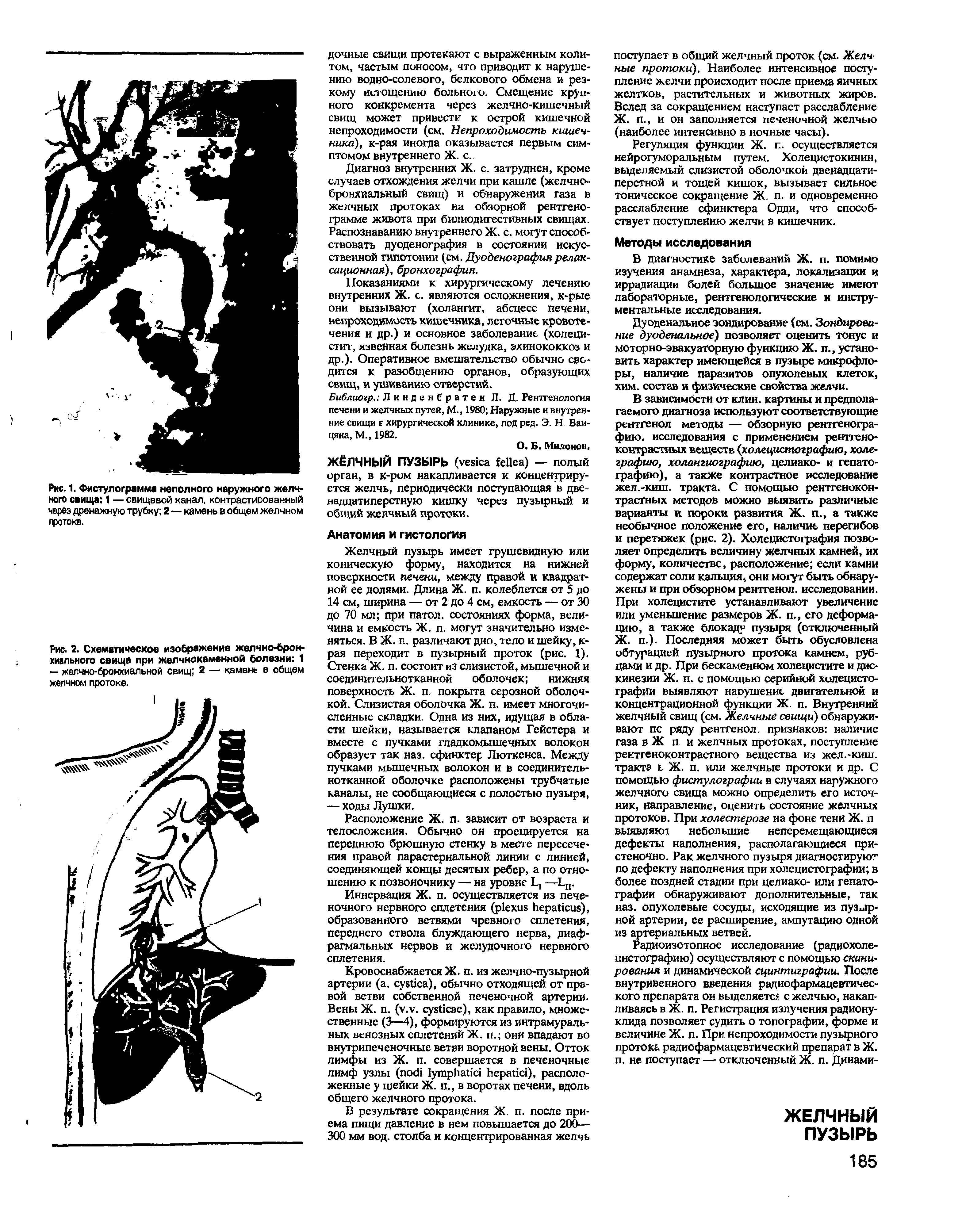 Рис. 2. Схематическое изображение желчно-бронхиального свища при желчнокаменной болезни 1 — желчно-бронхиальной свищ 2 — камень в общем желчном протоке.