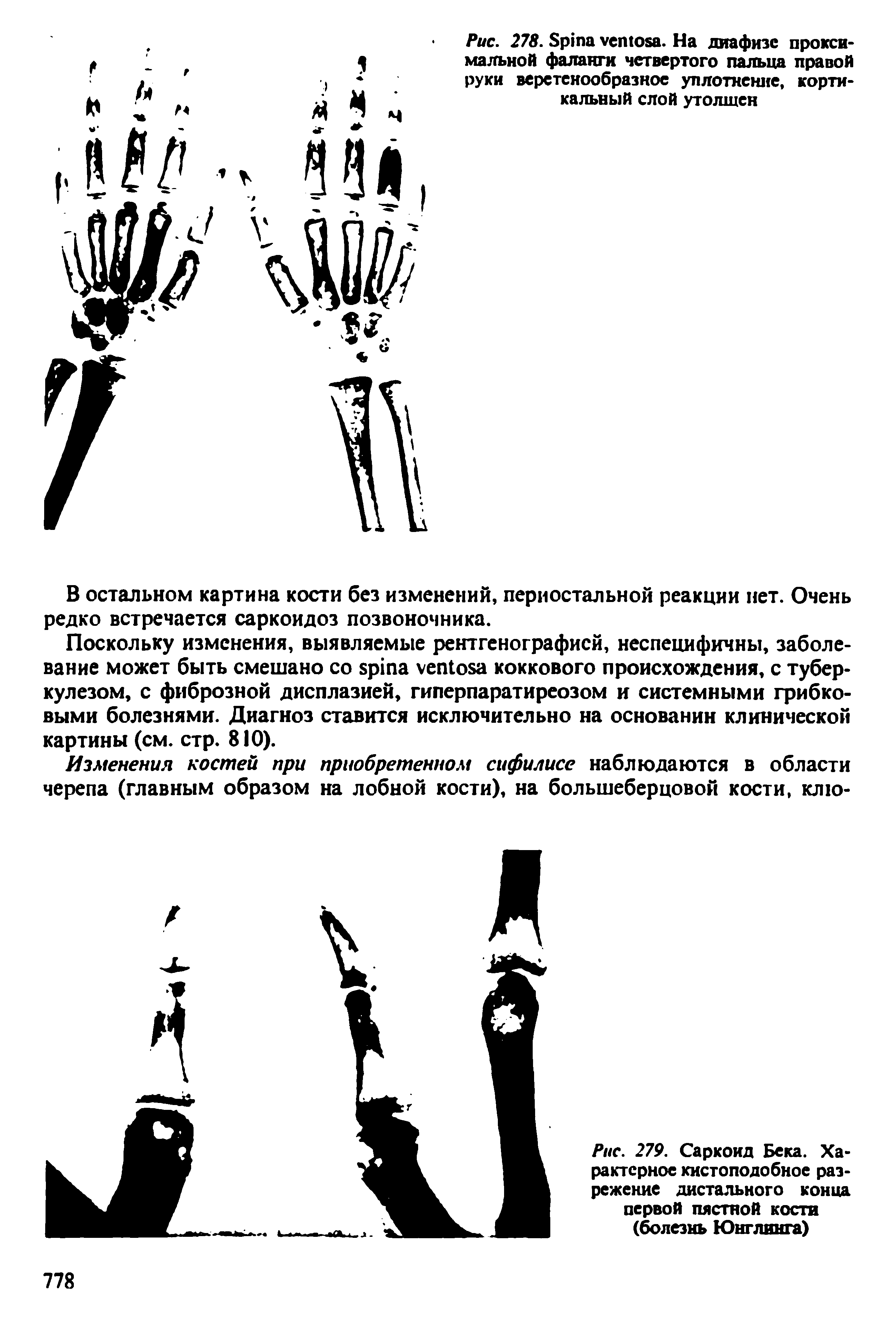 Рис. 279. Саркоид Бека. Характерное кистоподобное разрежение дистального конца первой пястной кости (болезнь Юнглинга)...