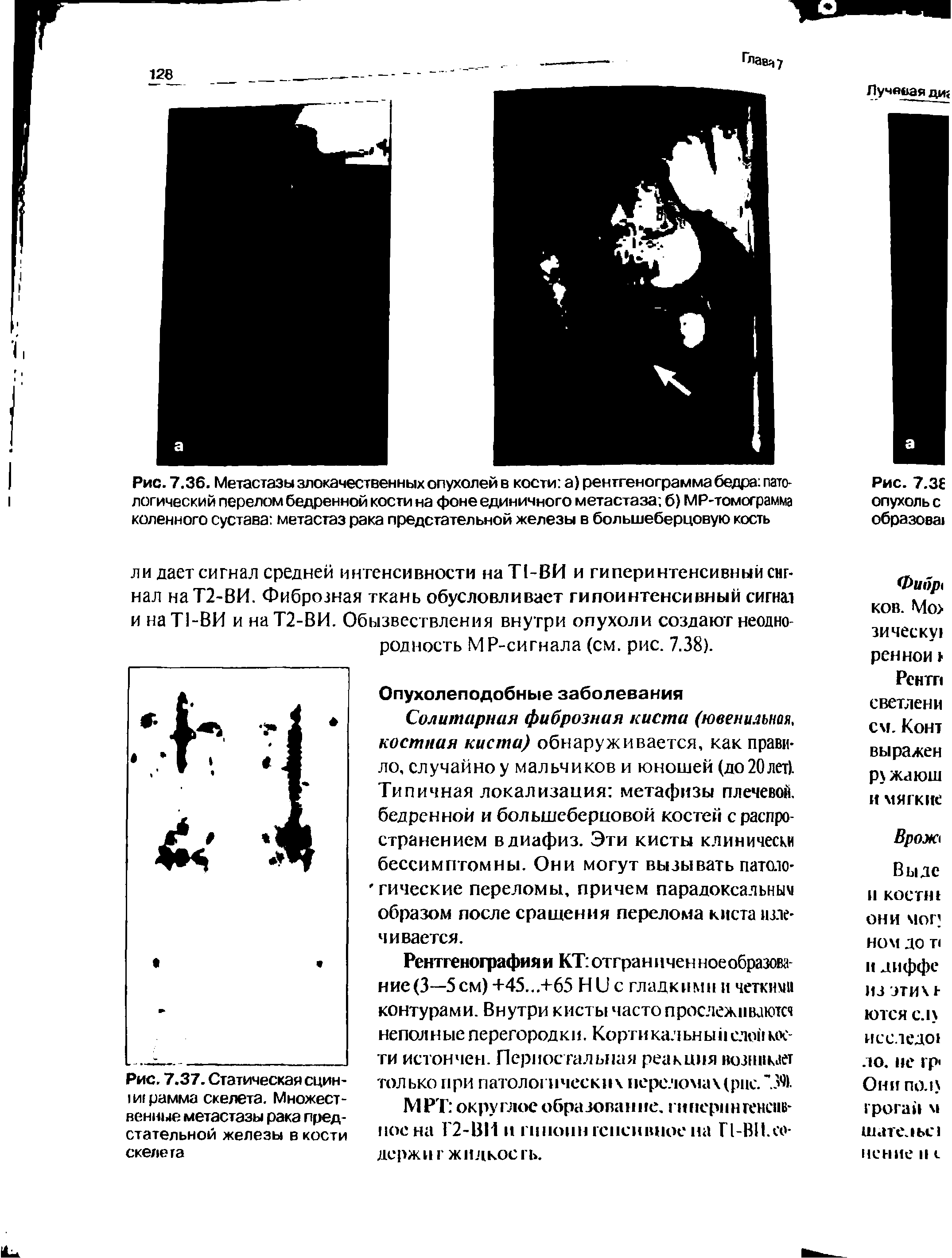 Рис. 7.36. Метастазы злокачественных опухолей в кости а) рентгенограмма бедра патологический перелом бедренной кости на фоне единичного метастаза б) МР-томограмма коленного сустава метастаз рака предстательной железы в большеберцовую кость...
