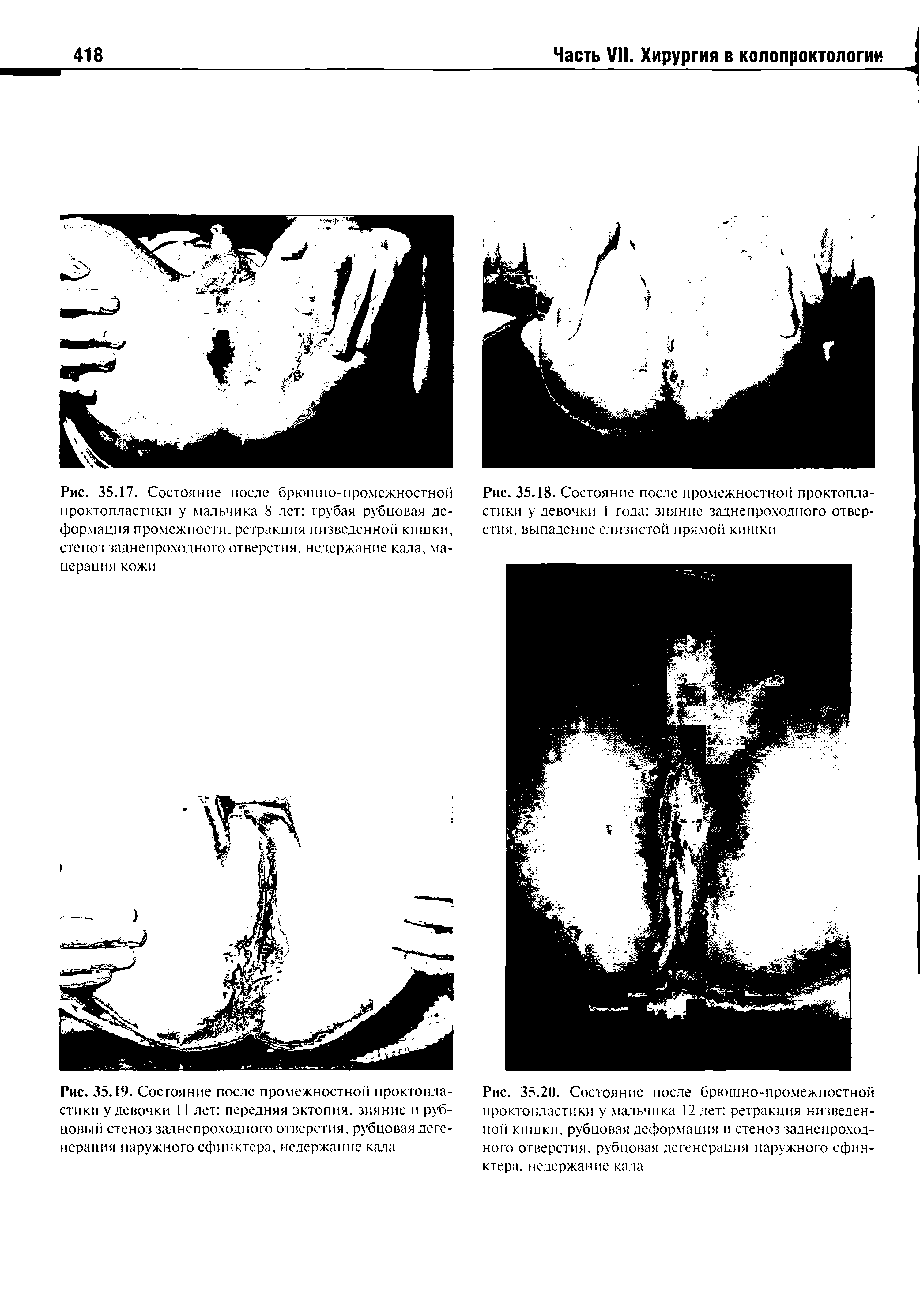 Рис. 35.19. Состояние после промежностной проктопластики у девочки 11 лет передняя эктопия, зияние и рубцовый стеноз заднепроходного отверстия, рубцовая дегенерация наружного сфинктера, недержание кала...