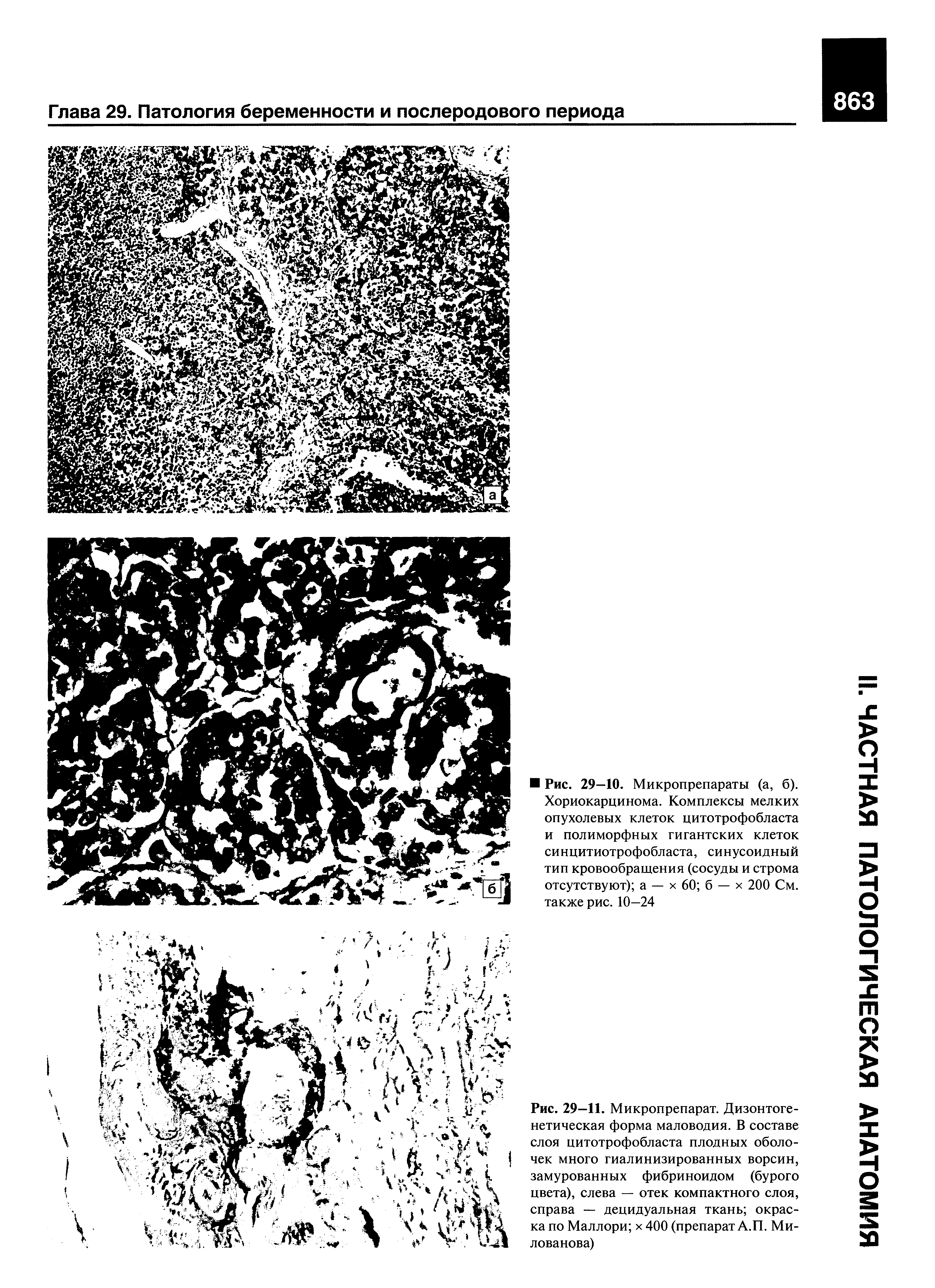 Рис. 29—11. Микропрепарат. Дизонтоге-нетическая форма маловодия. В составе слоя цитотрофобласта плодных оболочек много гиалинизированных ворсин, замурованных фибриноидом (бурого цвета), слева — отек компактного слоя, справа — децидуальная ткань окраска по Маллори х 400 (препарат А.П. Милованова)...
