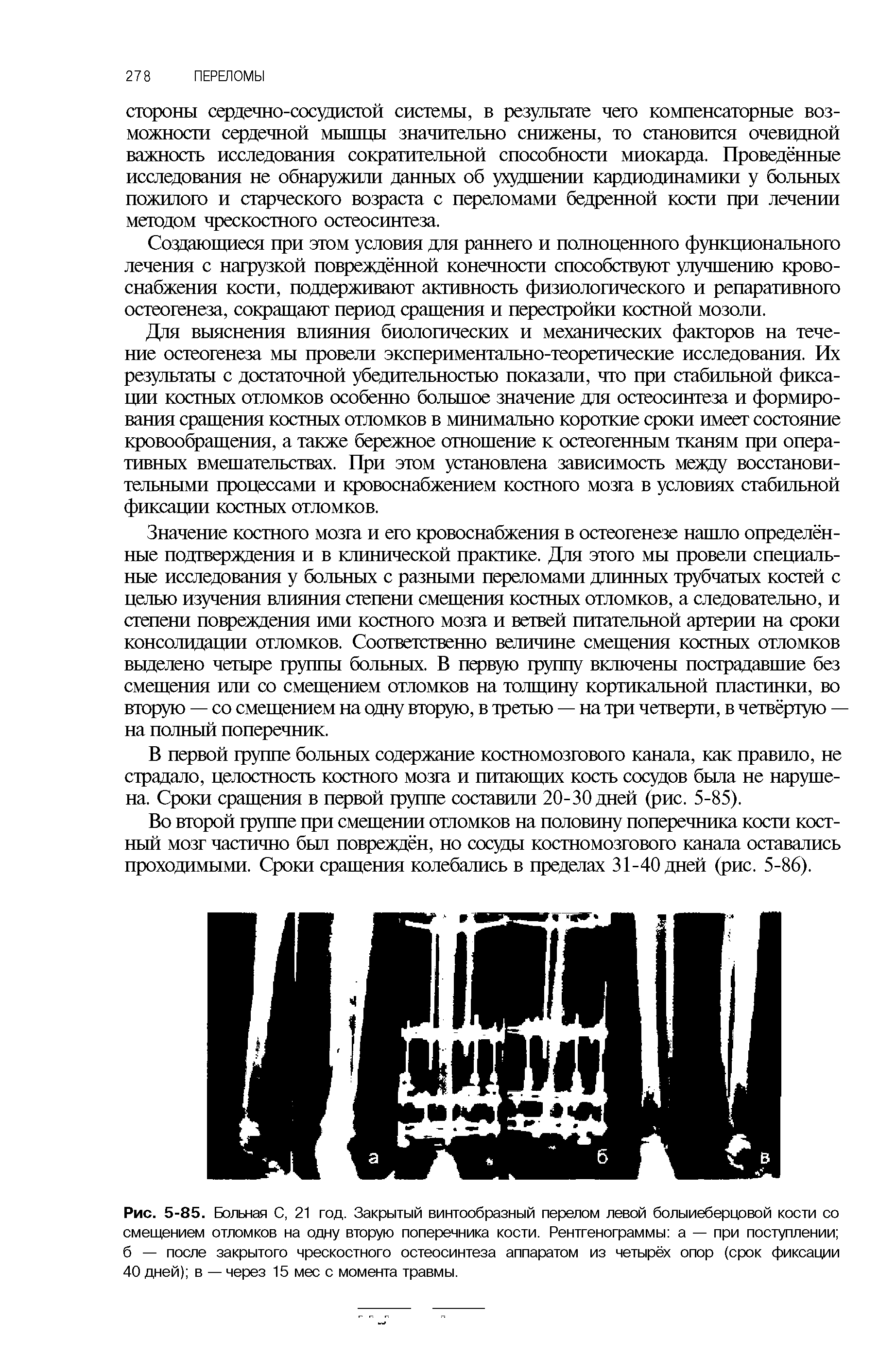 Рис. 5-85. Больная С, 21 год. Закрытый винтообразный перелом левой болыиеберцовой кости со смещением отломков на одну вторую поперечника кости. Рентгенограммы а — при поступлении б — после закрытого чрескостного остеосинтеза аппаратом из четырёх опор (срок фиксации 40 дней) в — через 15 мес с момента травмы.