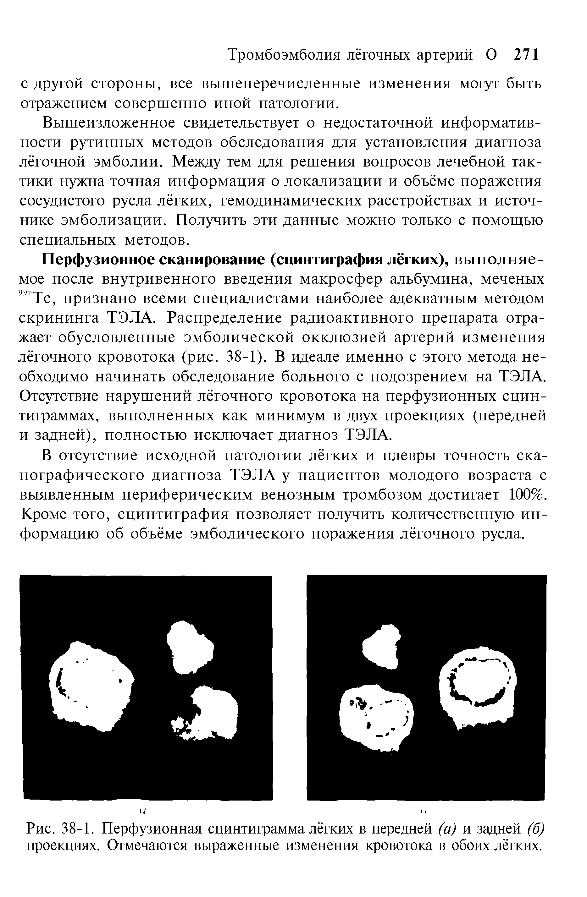 Рис. 38-1. Перфузионная сцинтиграмма лёгких в передней (а) и задней (б) проекциях. Отмечаются выраженные изменения кровотока в обоих лёгких.