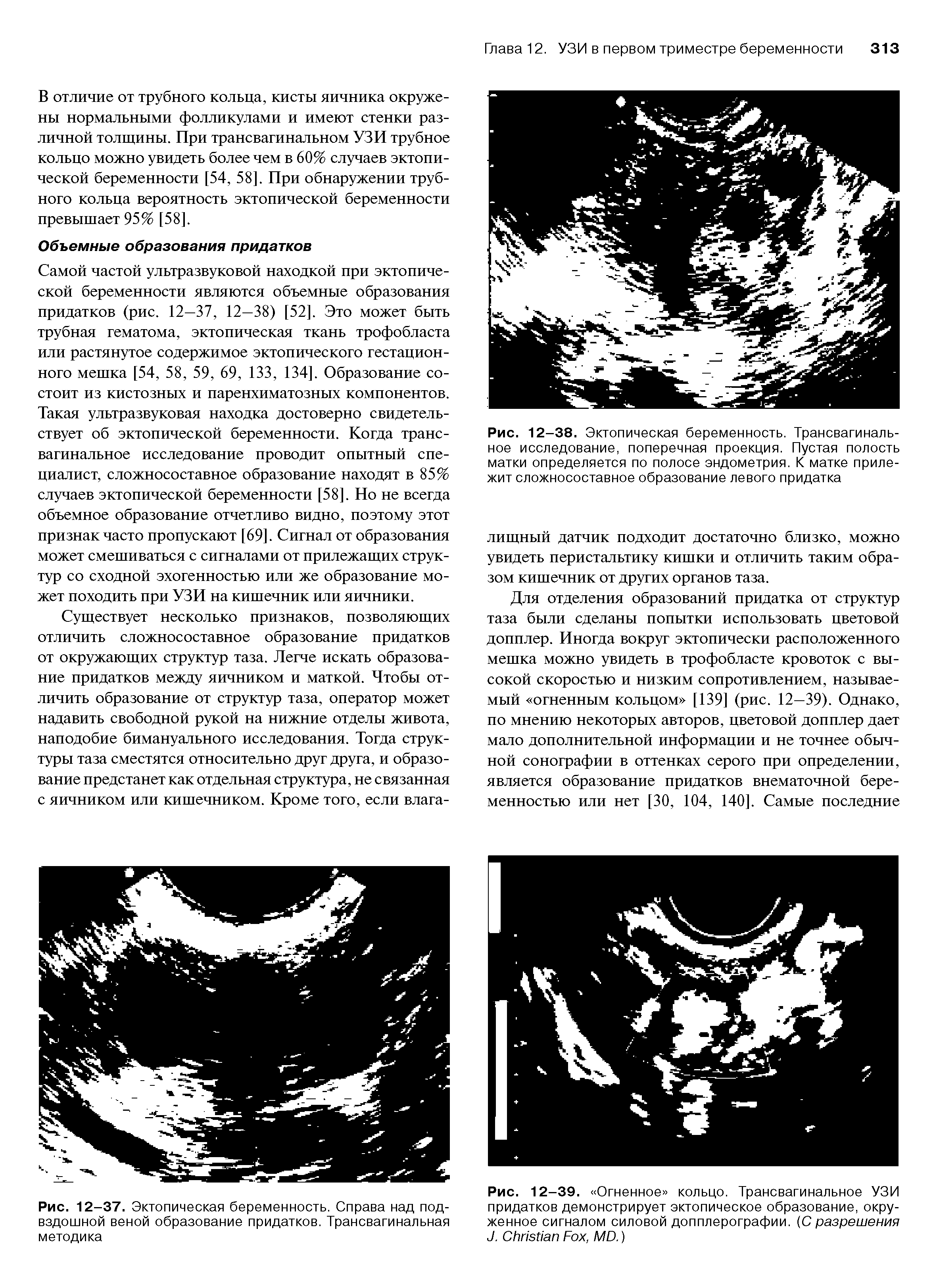 Рис. 12-38. Эктопическая беременность. Трансвагинальное исследование, поперечная проекция. Пустая полость матки определяется по полосе эндометрия. К матке прилежит сложносоставное образование левого придатка...