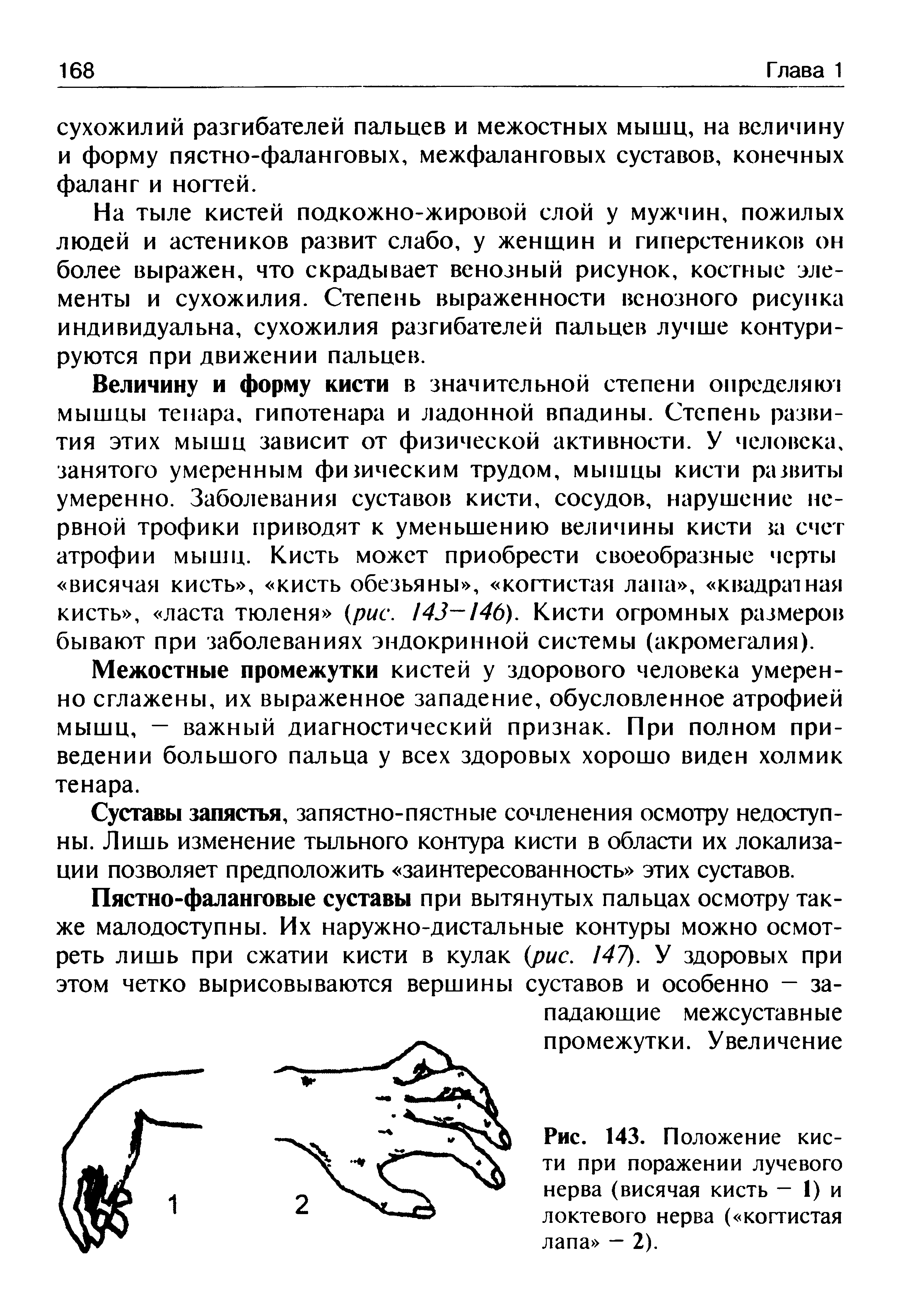 Рис. 143. Положение кисти при поражении лучевого нерва (висячая кисть — 1) и локтевого нерва ( когтистая лапа — 2).